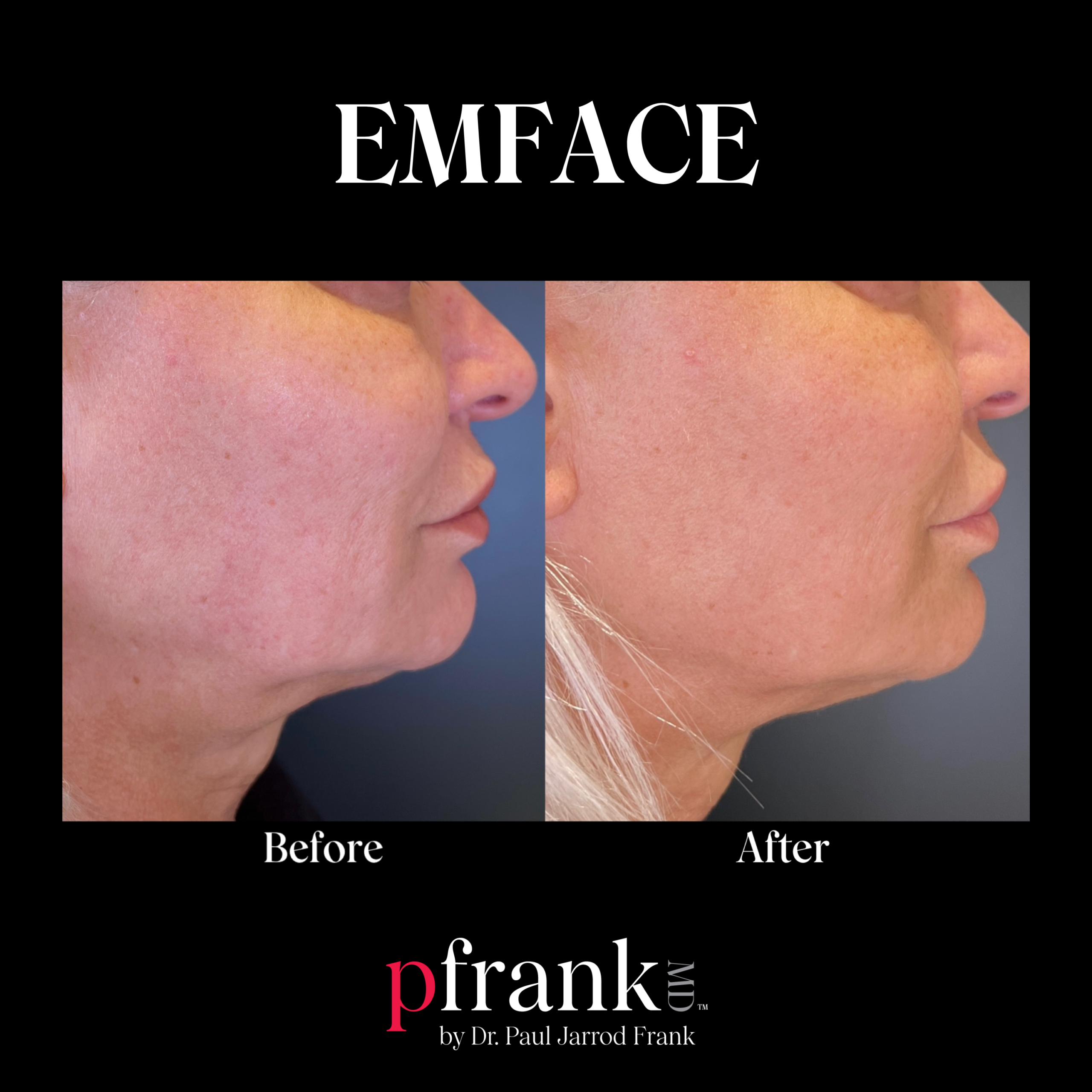 Emface for Skin Tightening