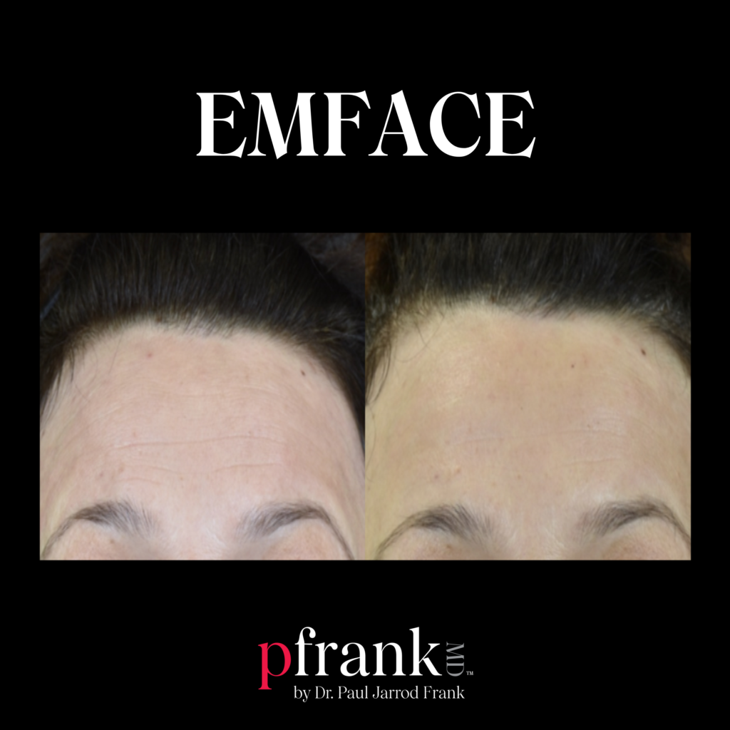 Emface for Skin Tightening