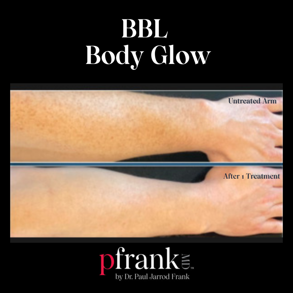 BBL Body Glow for Sun Damage