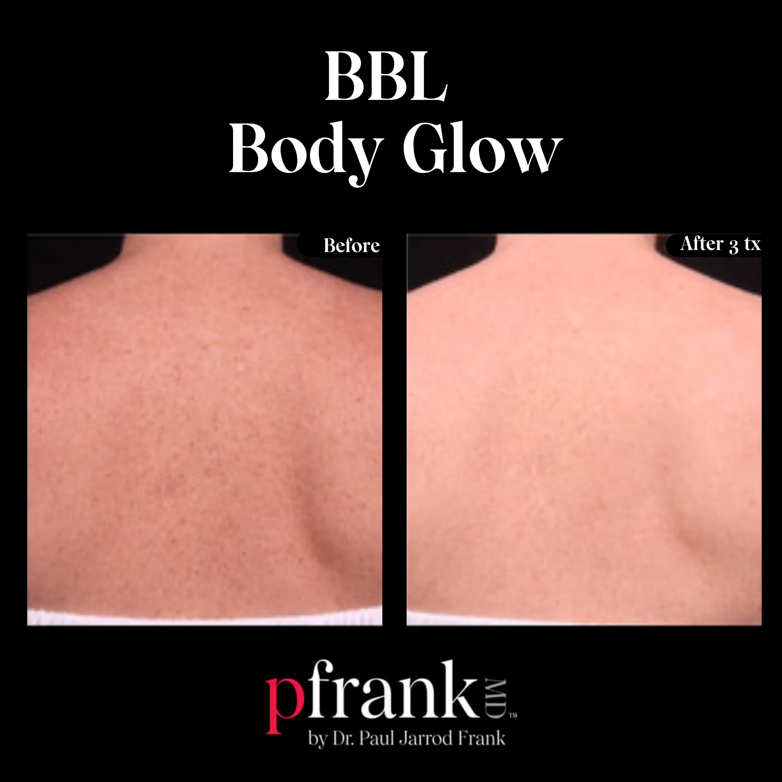 BBL Body Glow for Sun Damage