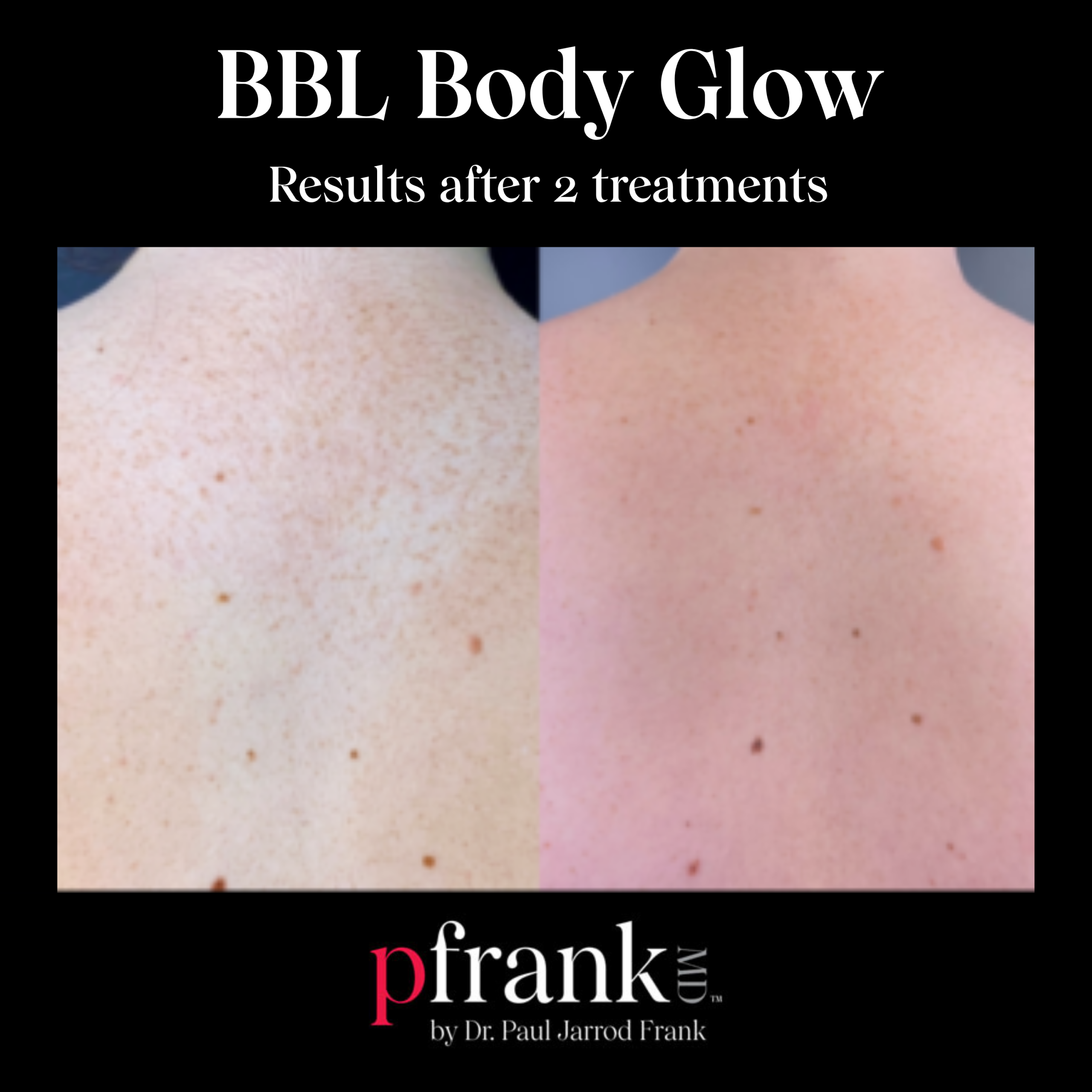 BBL Body Glow for Sun Damage