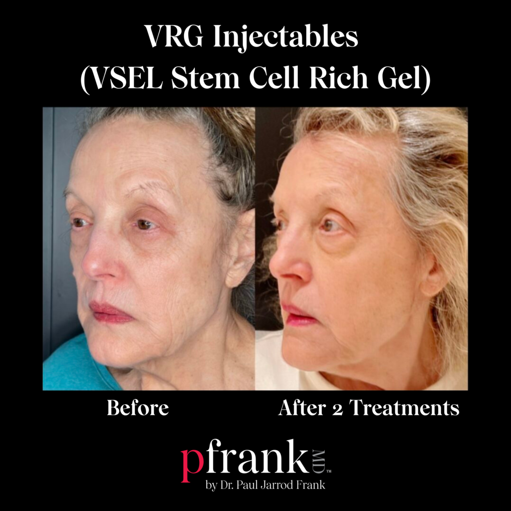 Regenerative Stem Cell Injectable Volumization