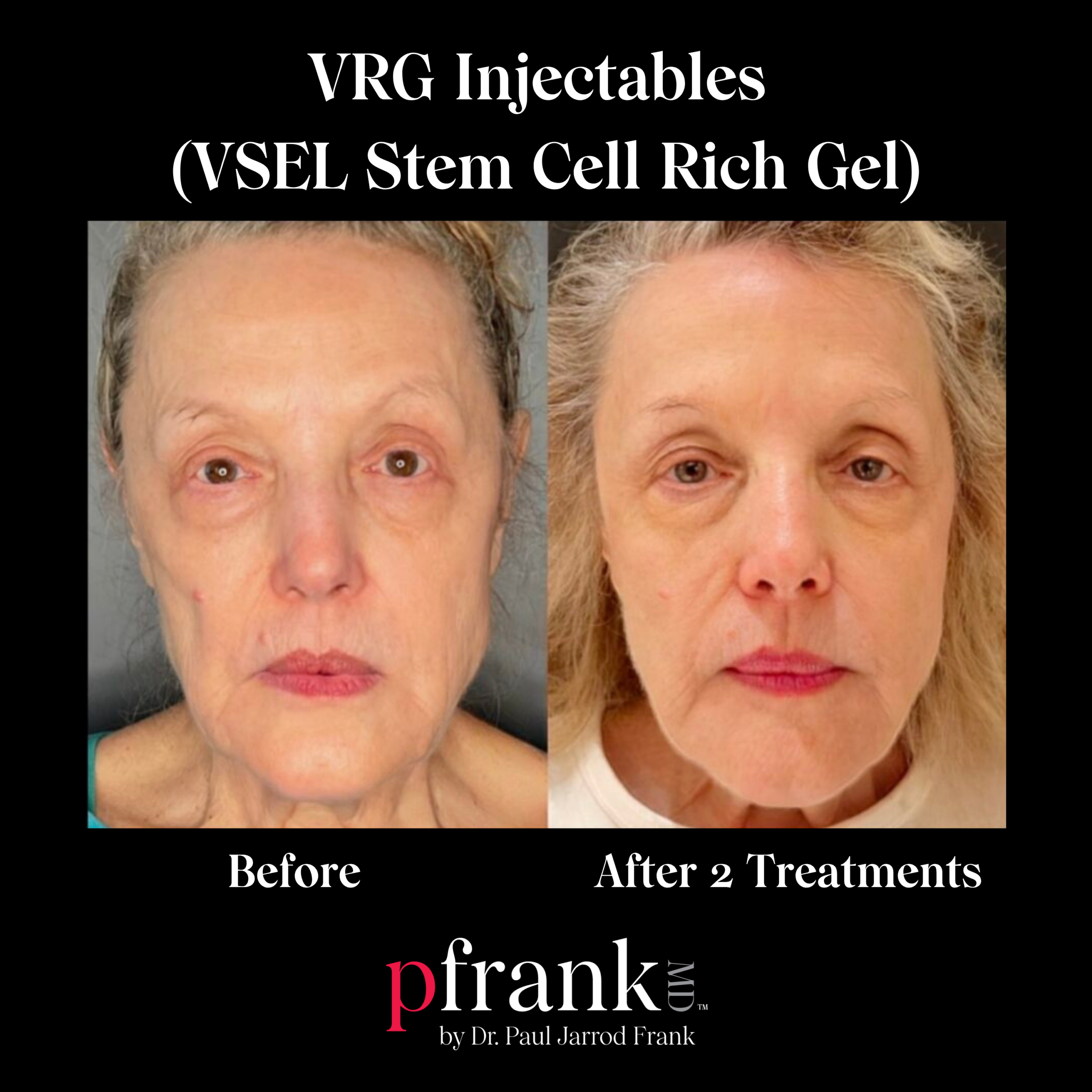 Regenerative Stem Cell Injectable Volumization