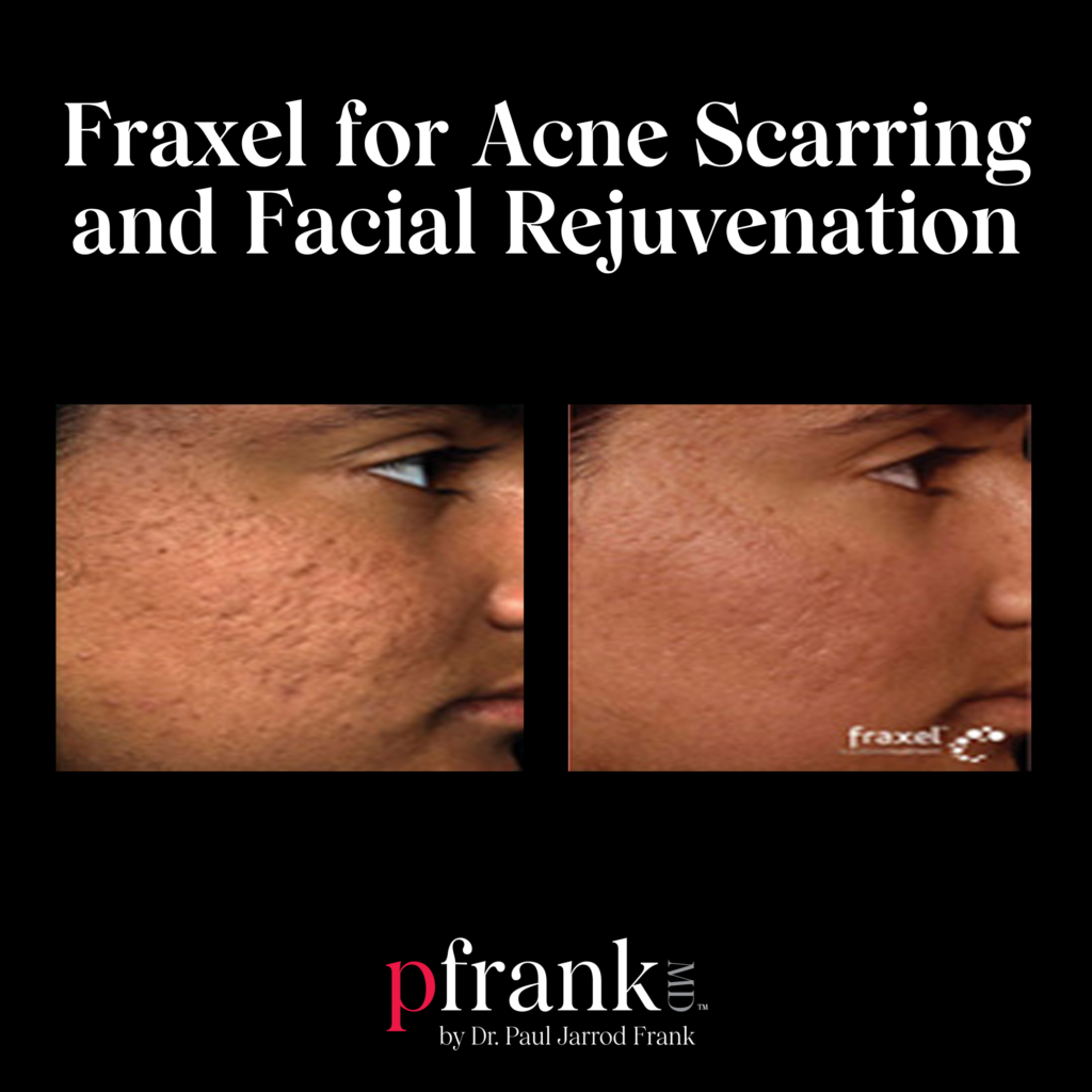 Fraxel for Acne Scars