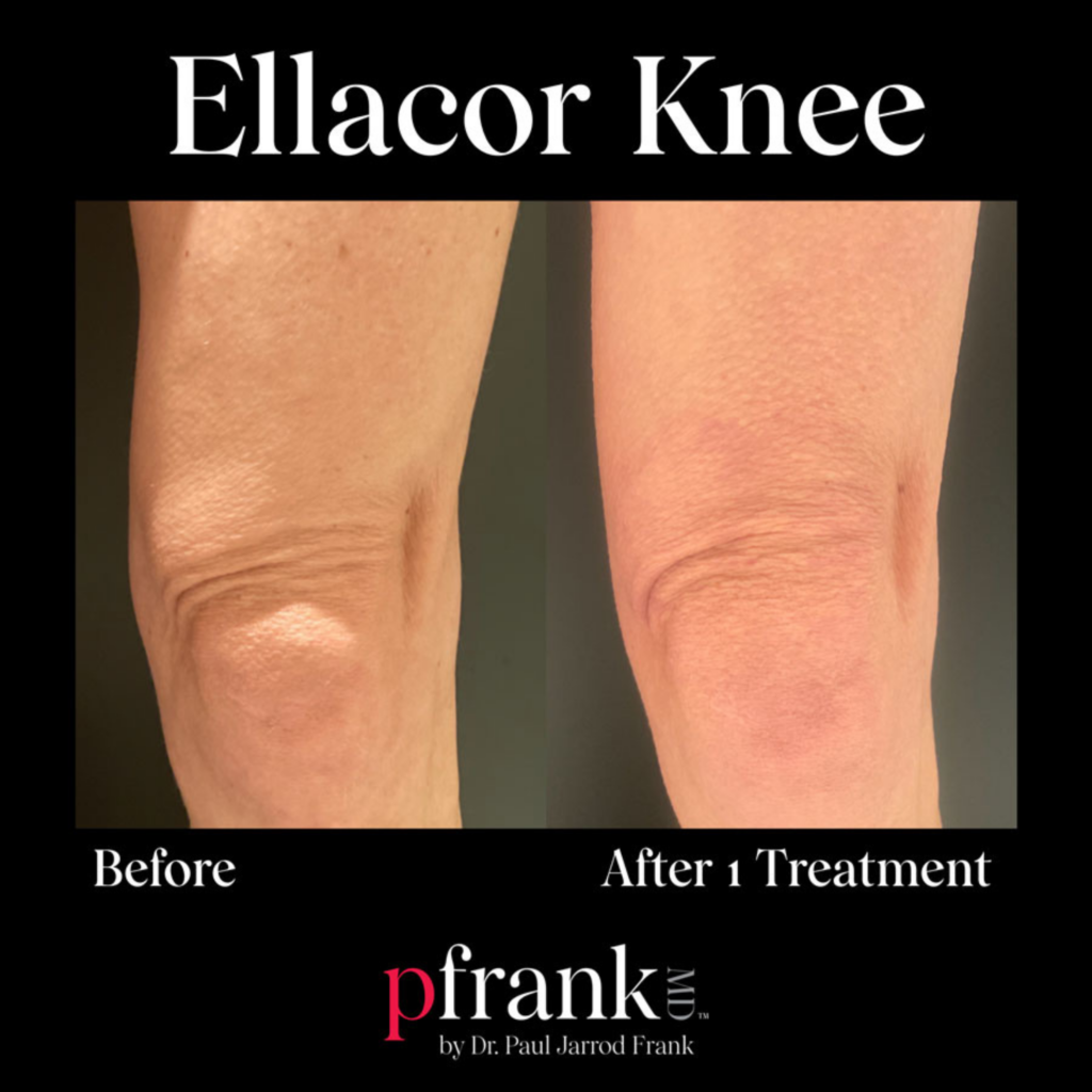 Ellacor for Wrinkly Knees