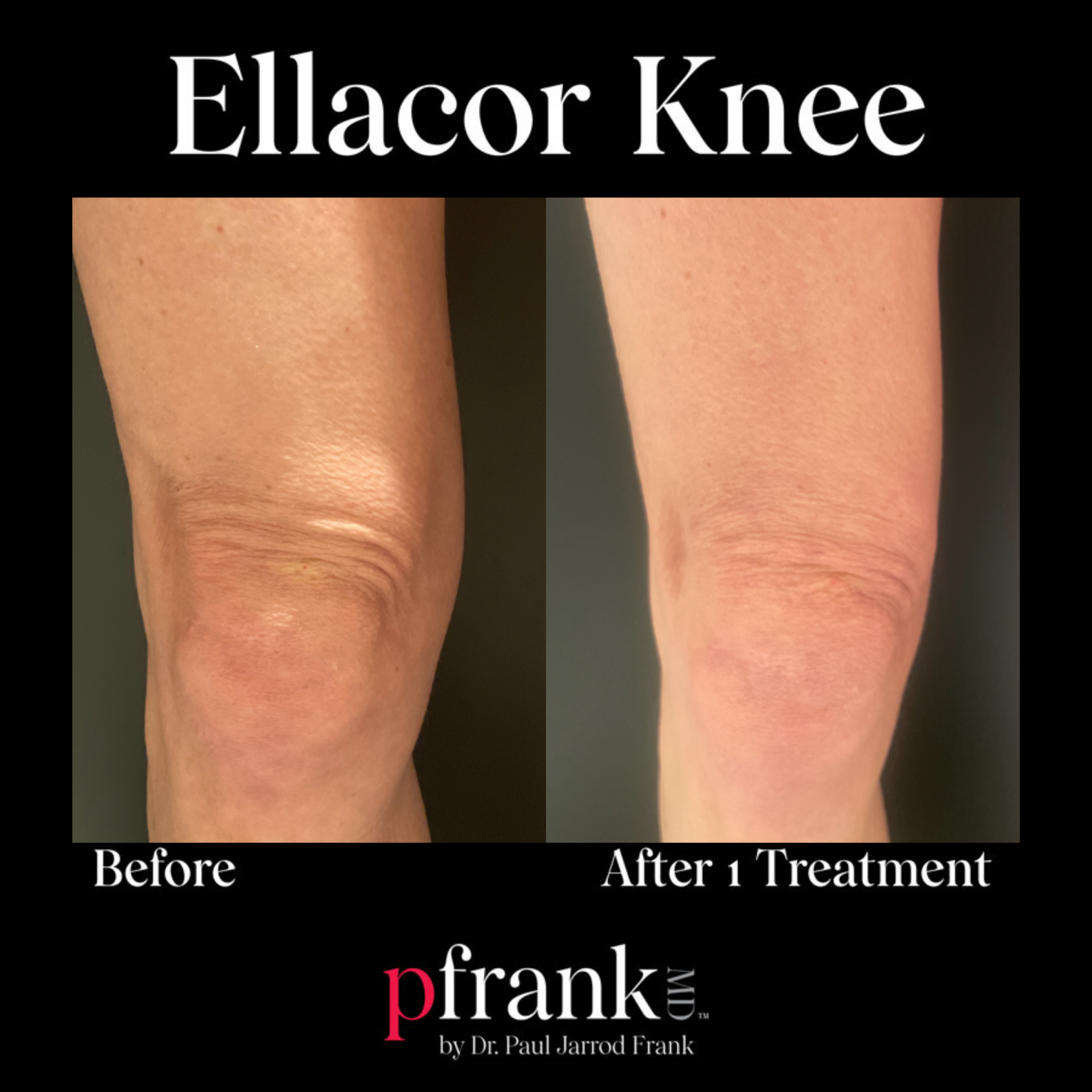 Ellacor for Wrinkly Knees