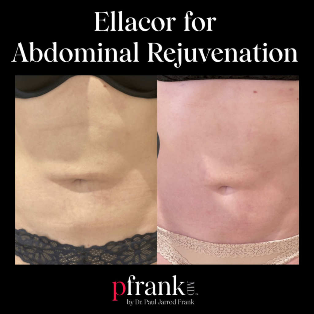 Ellacor for Abdominal Rejuvenation