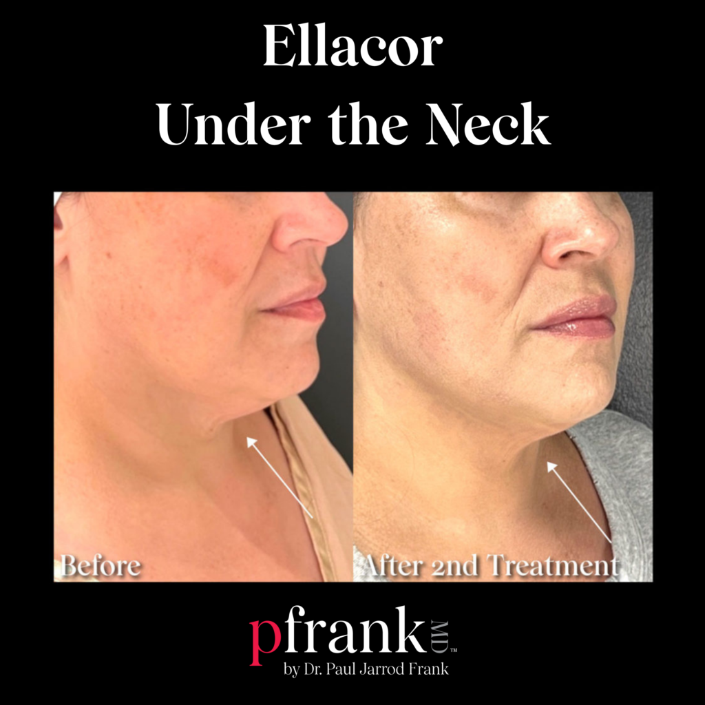 Ellacor Under the Neck Laxity
