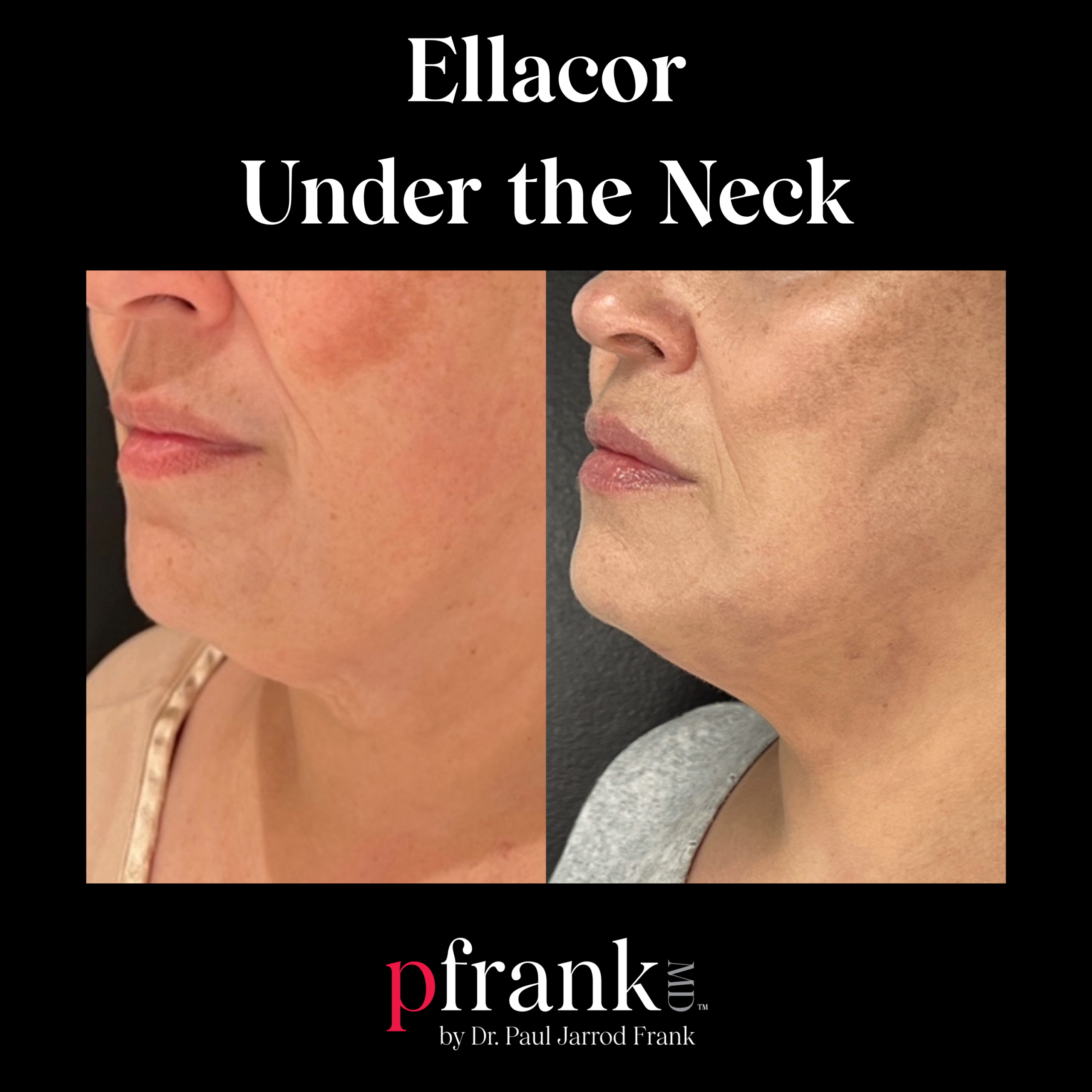 Ellacor Under the Neck Laxity