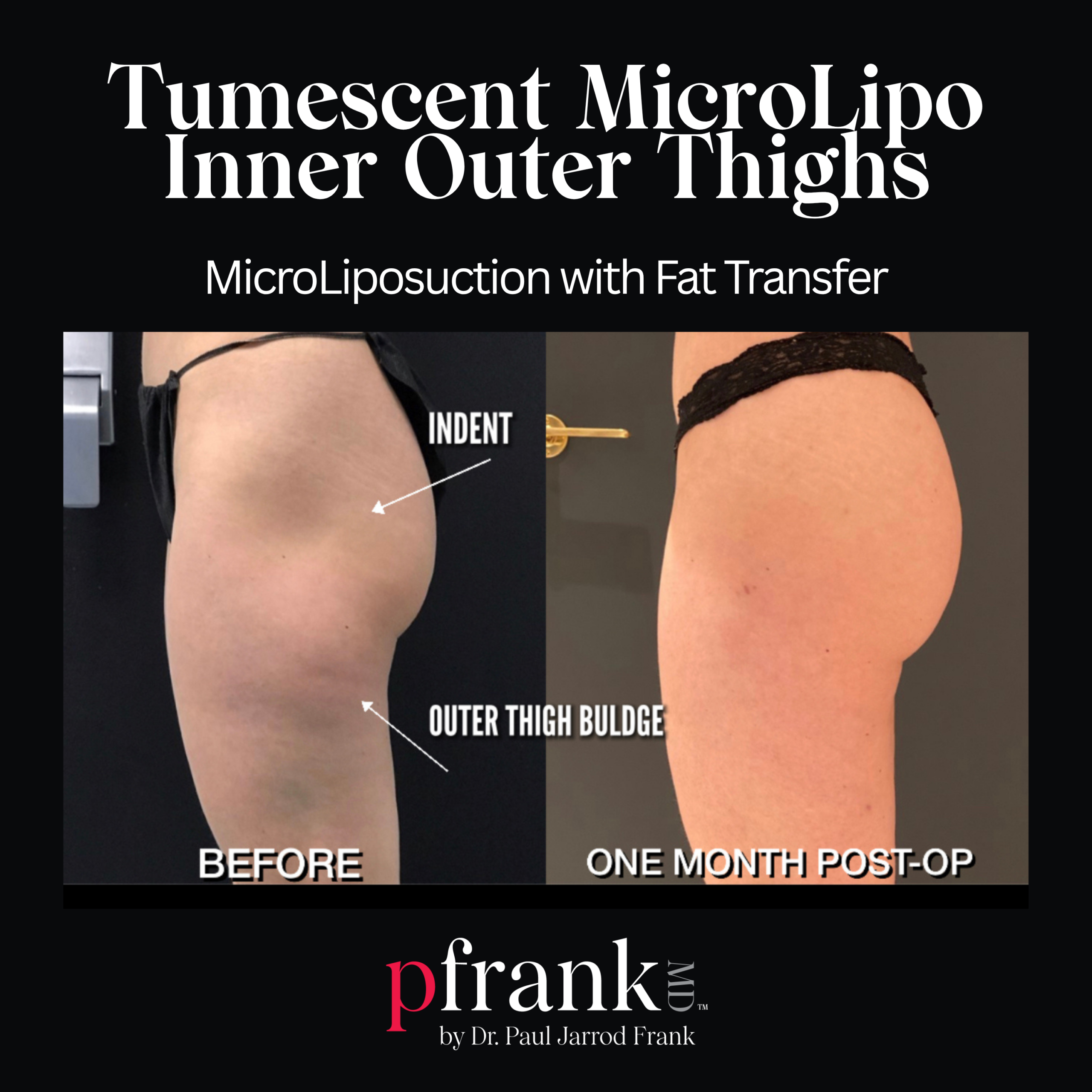 Tumescent Micro Lipo for Thigh Bulge