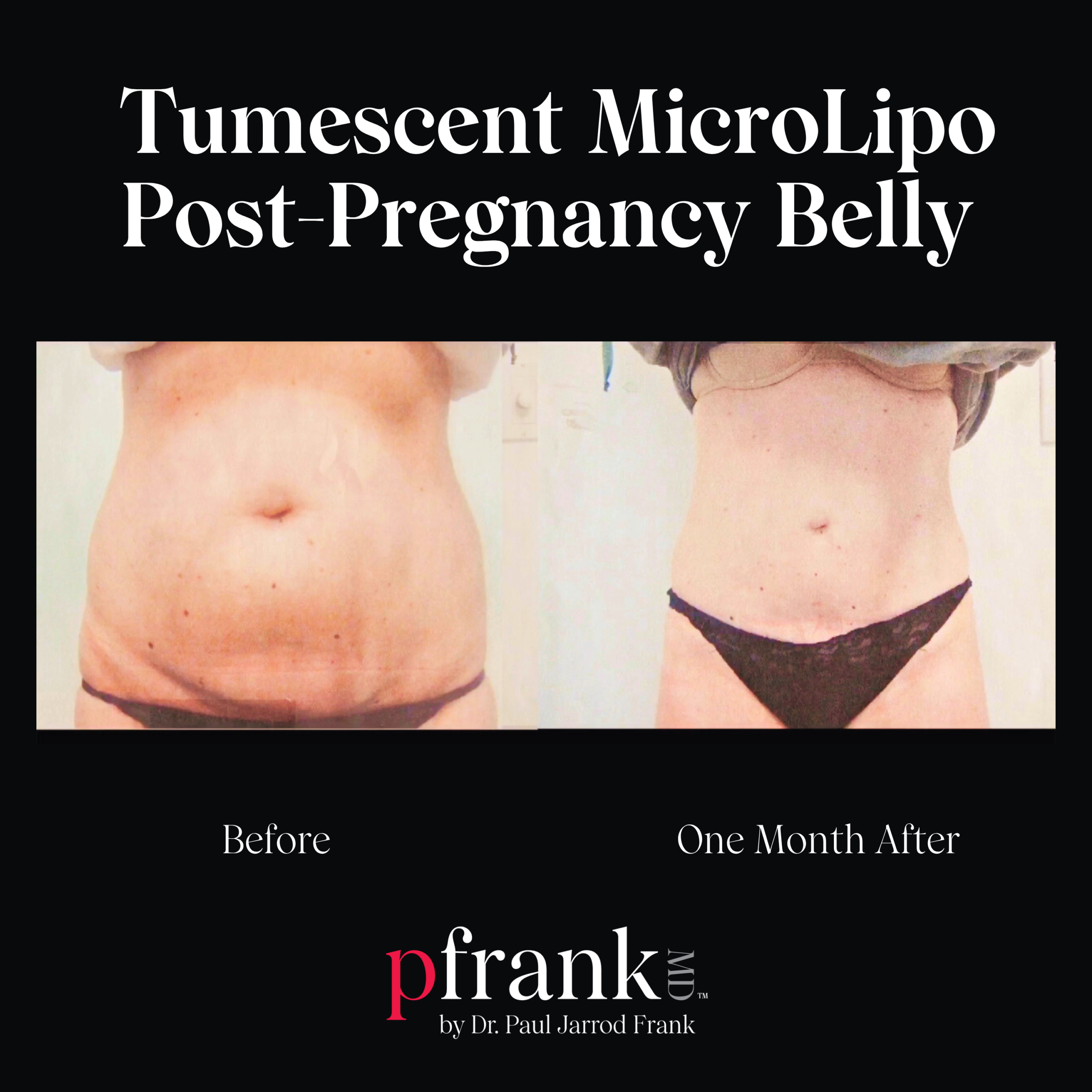 Tumescent Micro Lipo for Abdominal Rejuvenation