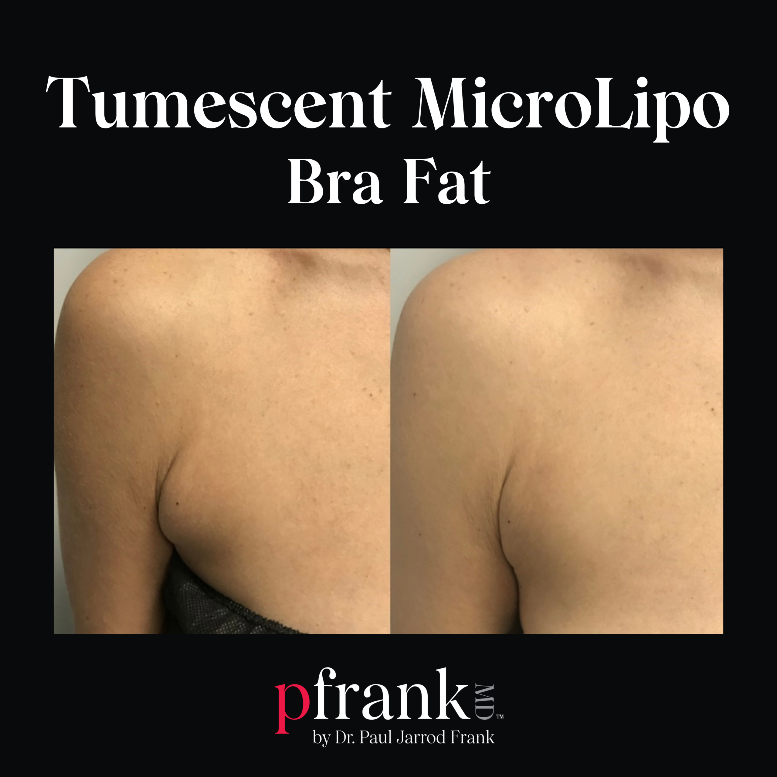 Tumescent Micro Lipo for Abdominal Rejuvenation