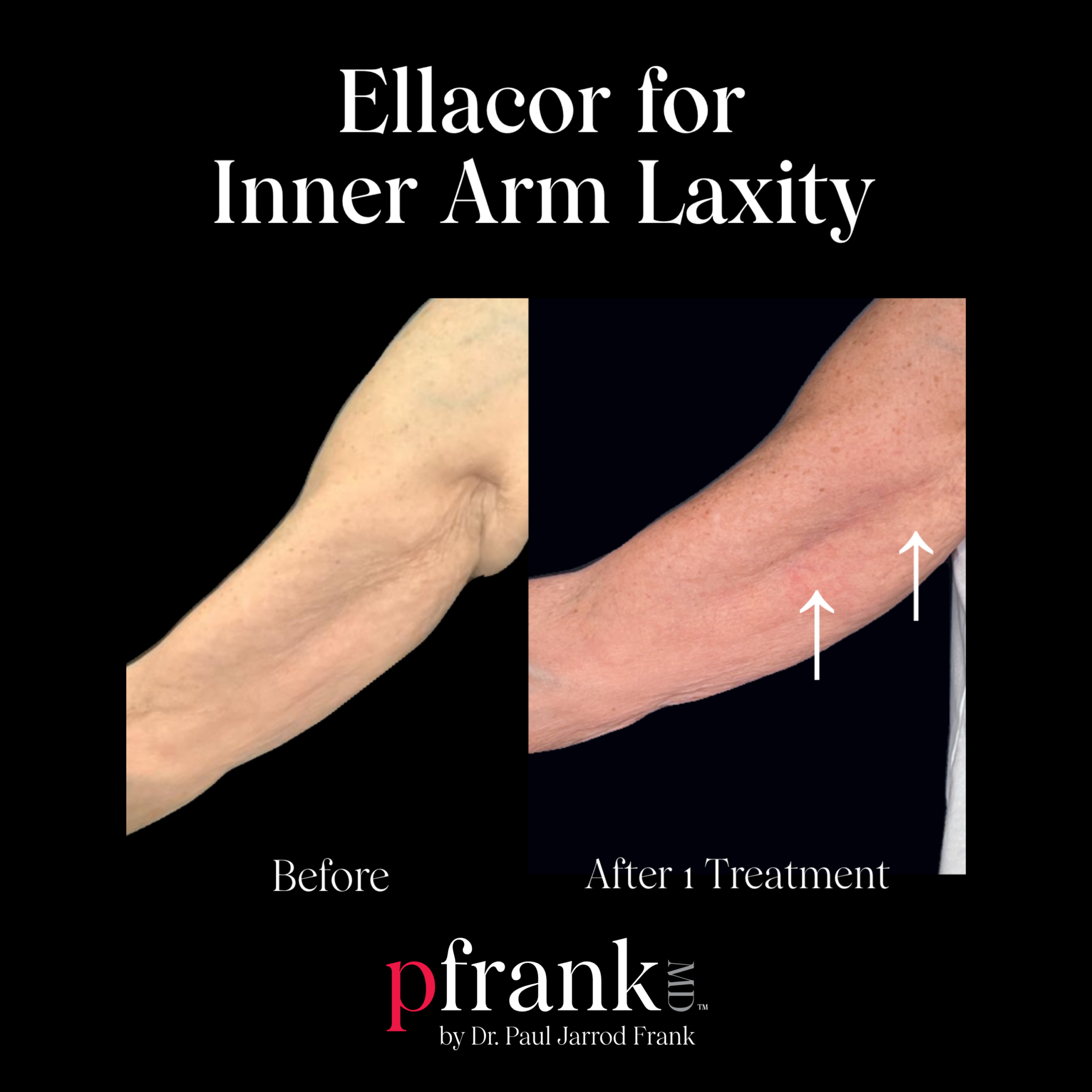 Ellacor for Inner Arm Laxity
