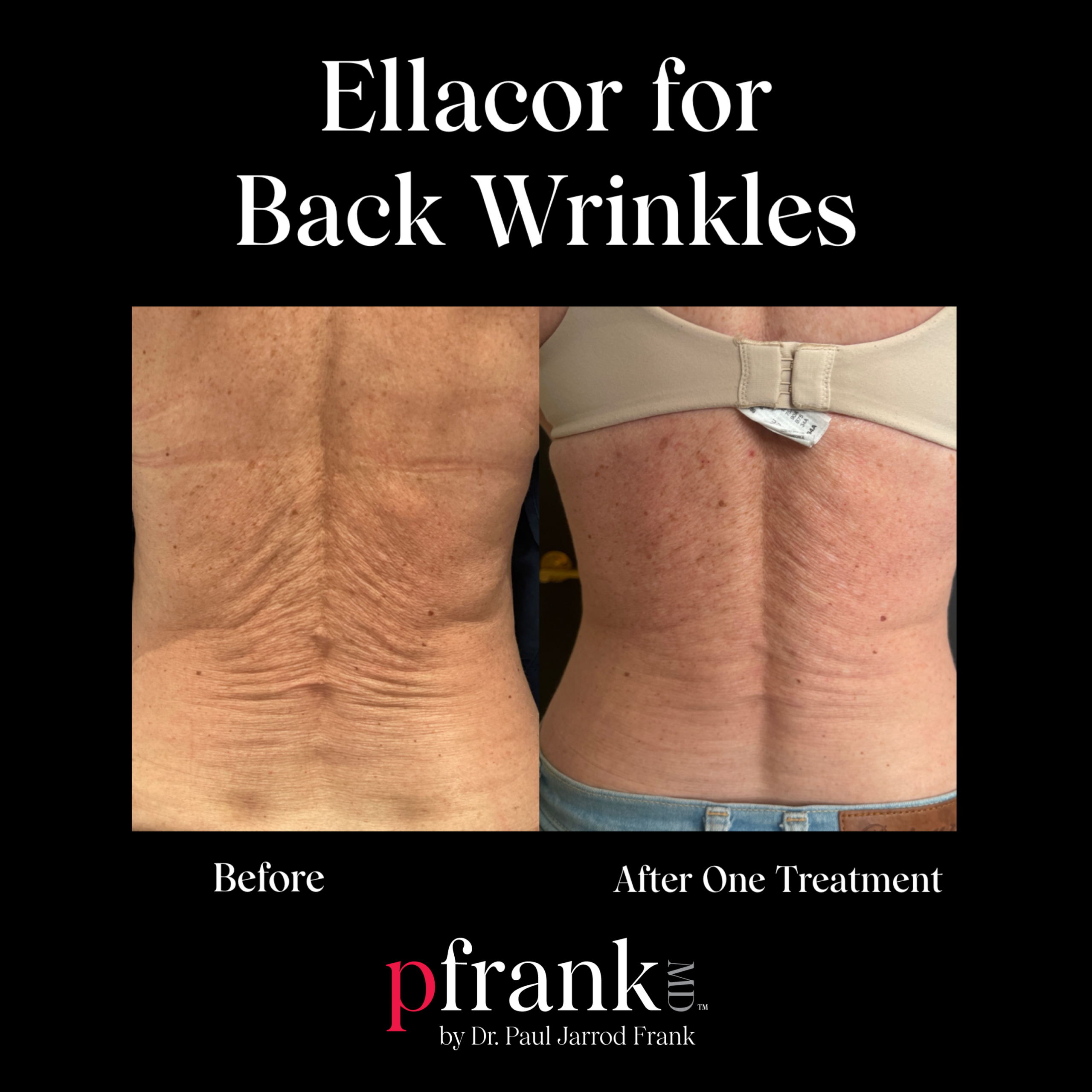 Ellacor for Back Wrinkles