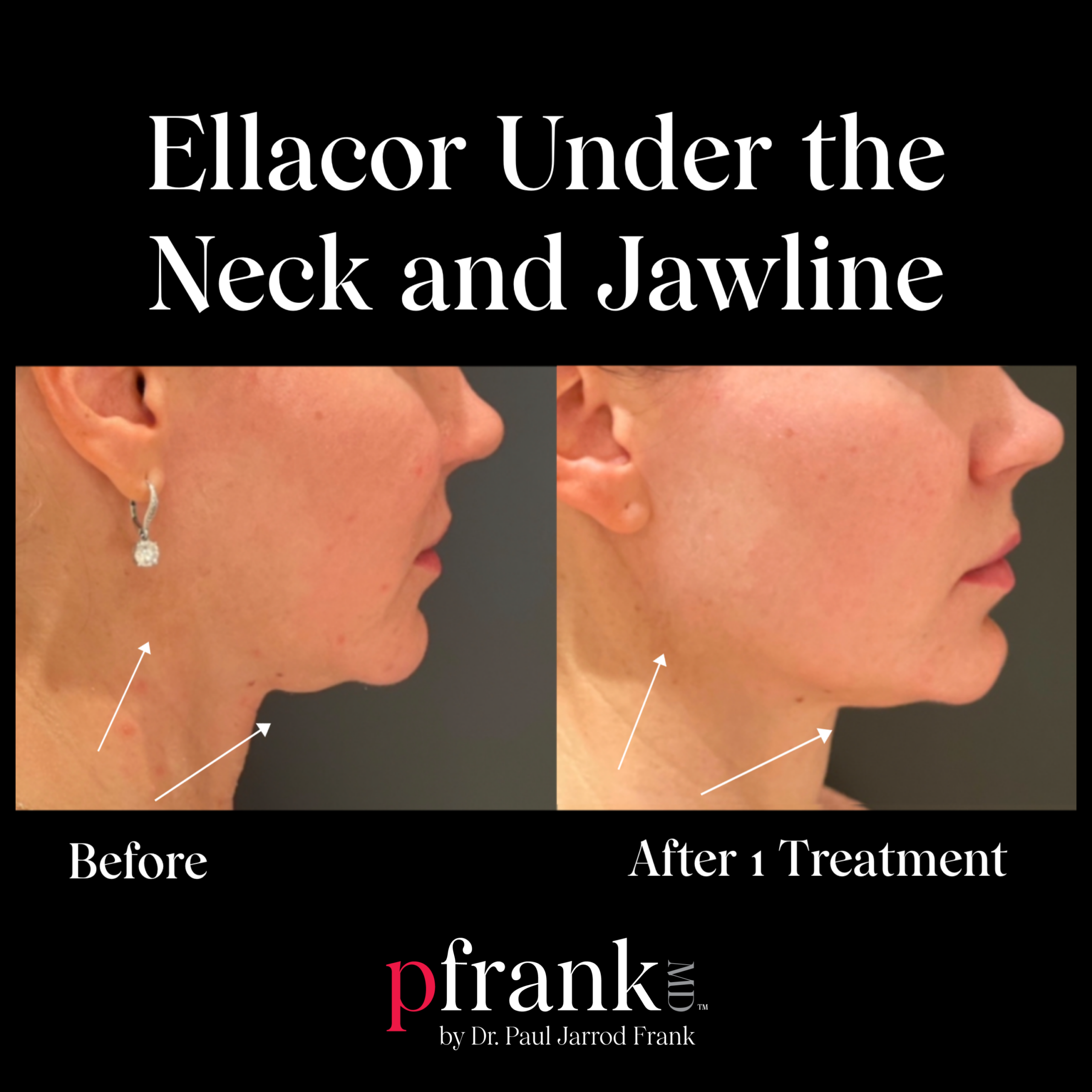 Under Neck Laxity and Jowls