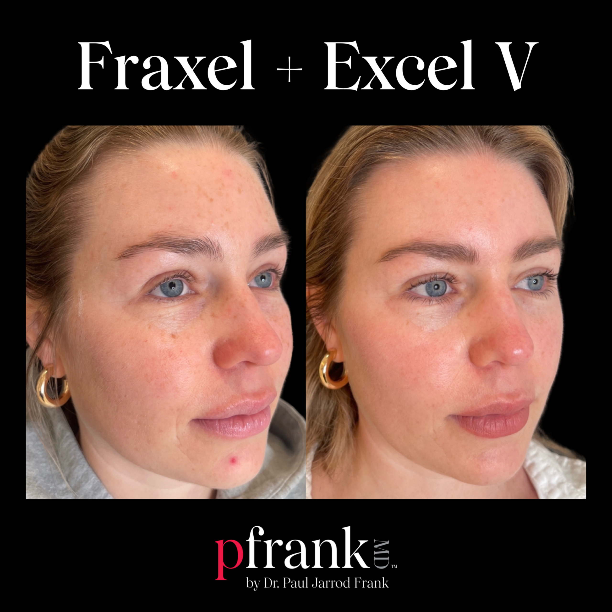 Fraxel for Sun Damage