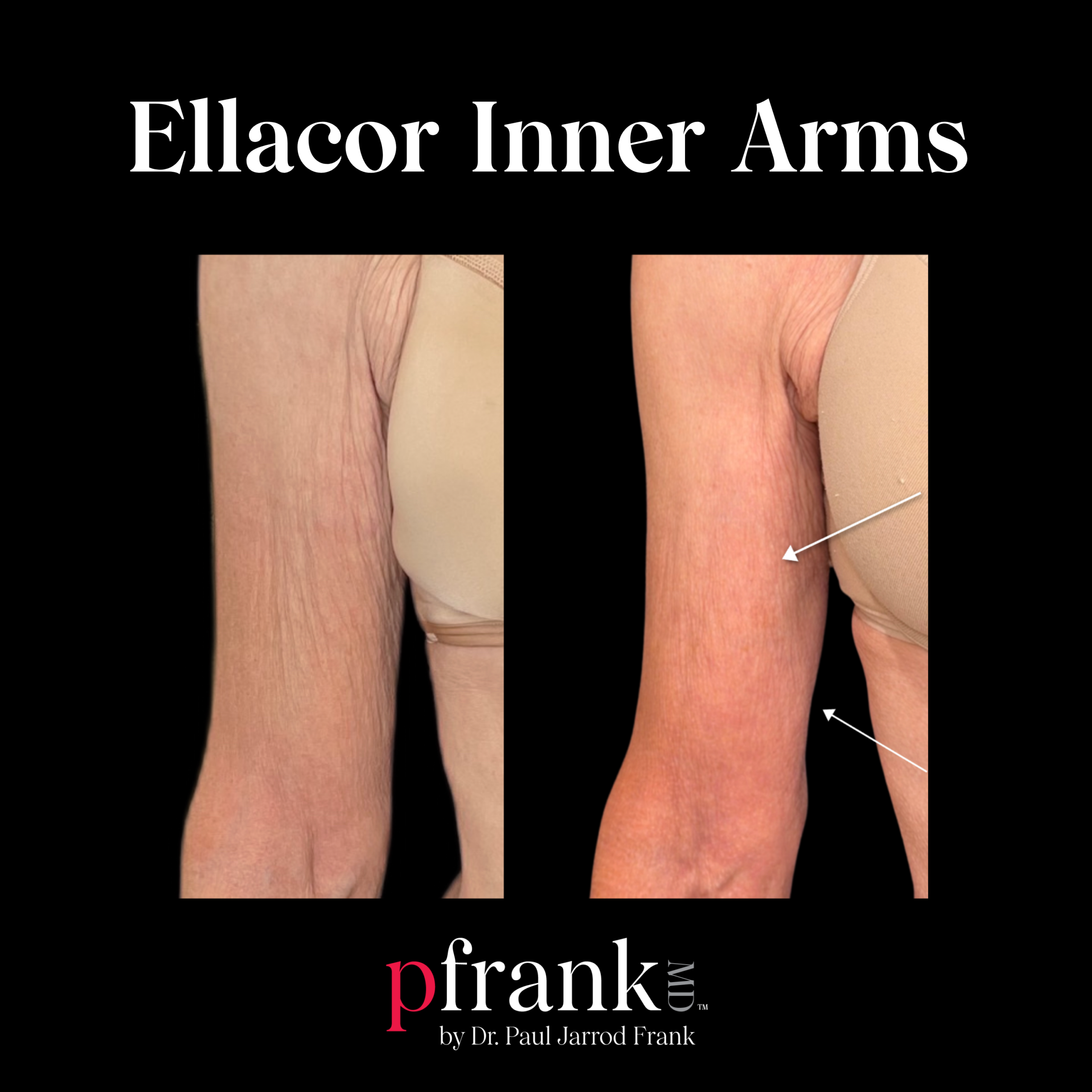 Ellacor for Inner Arm Laxity