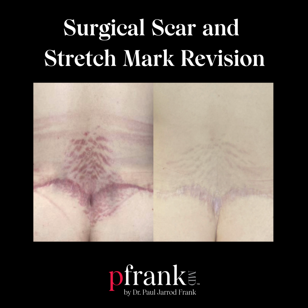 Miria for Stretch Mark Treatment