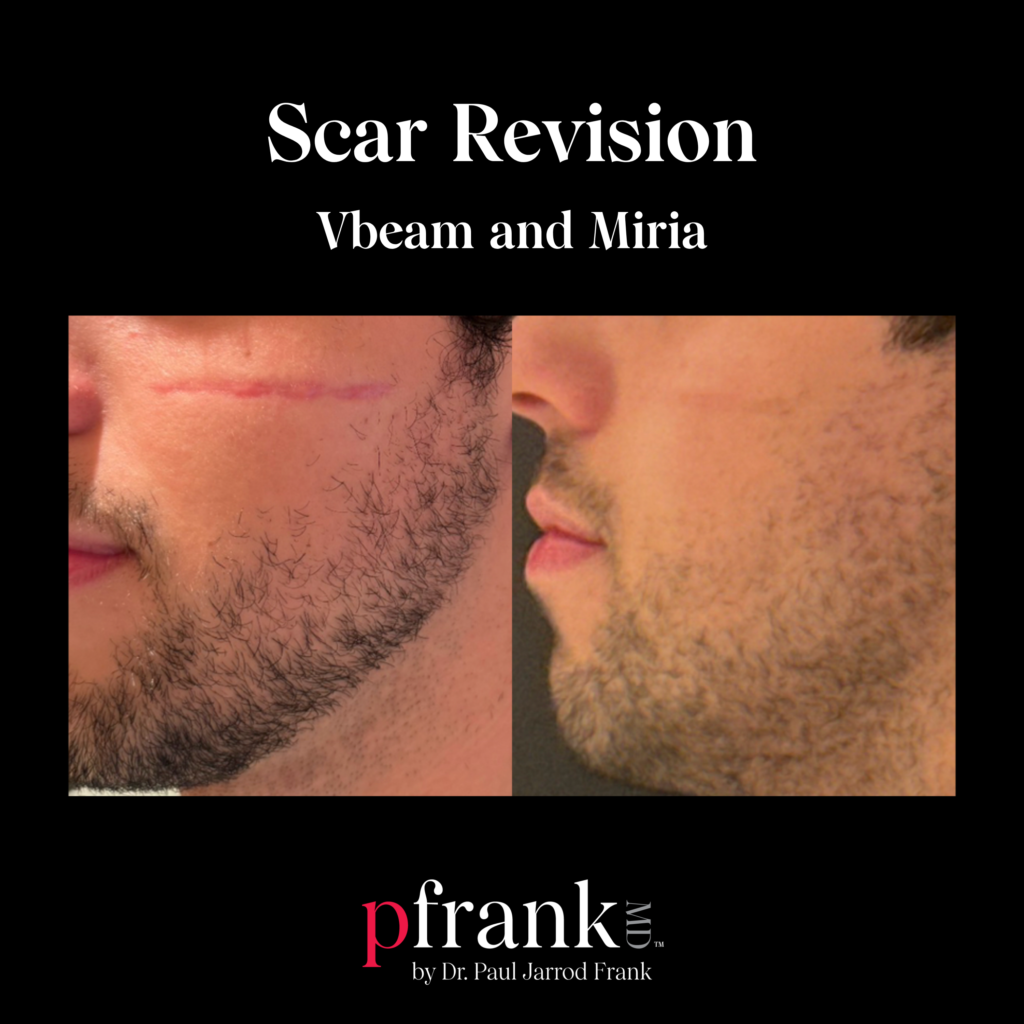 Miria and Vbeam for Scar Treatment