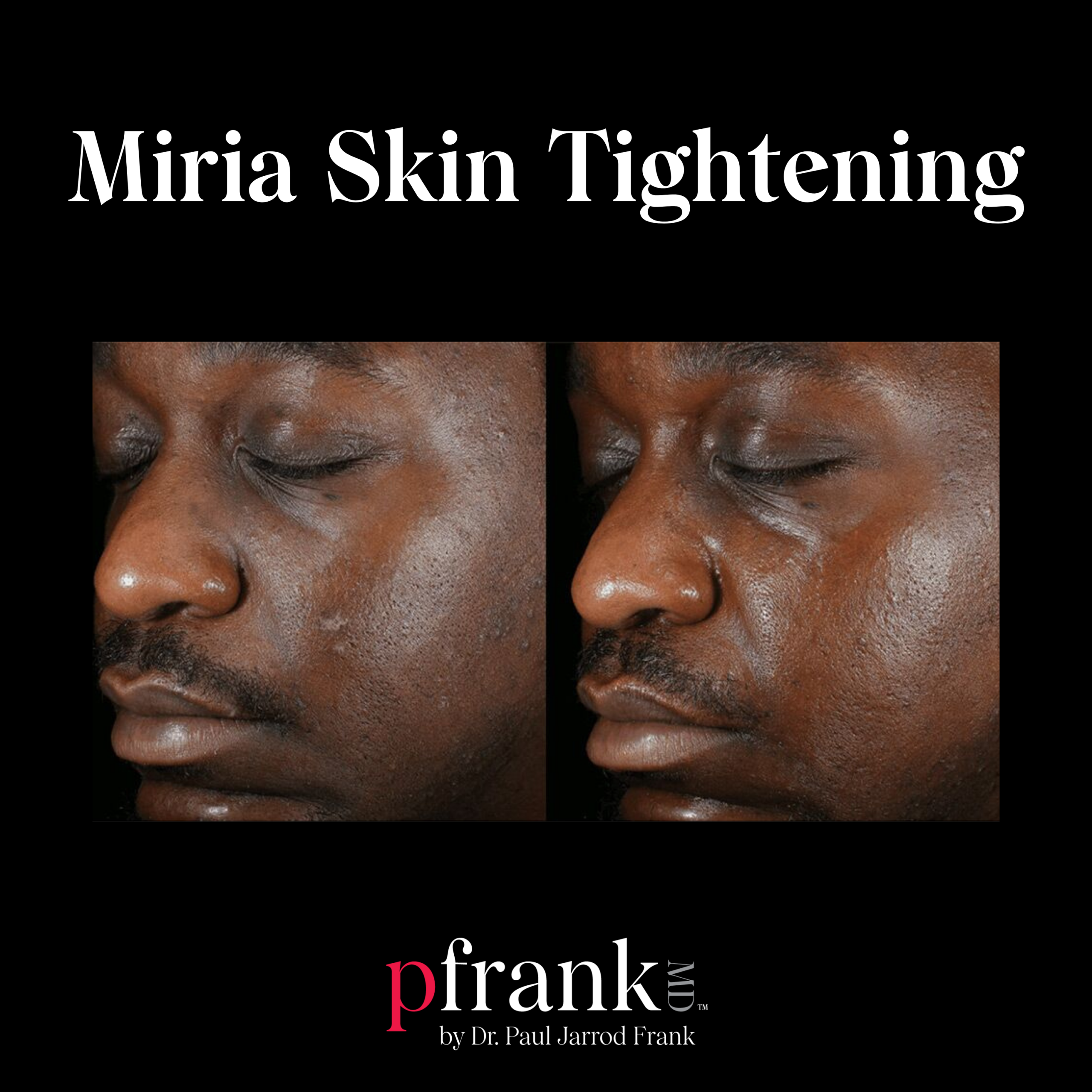 Miria for Skin Tightening