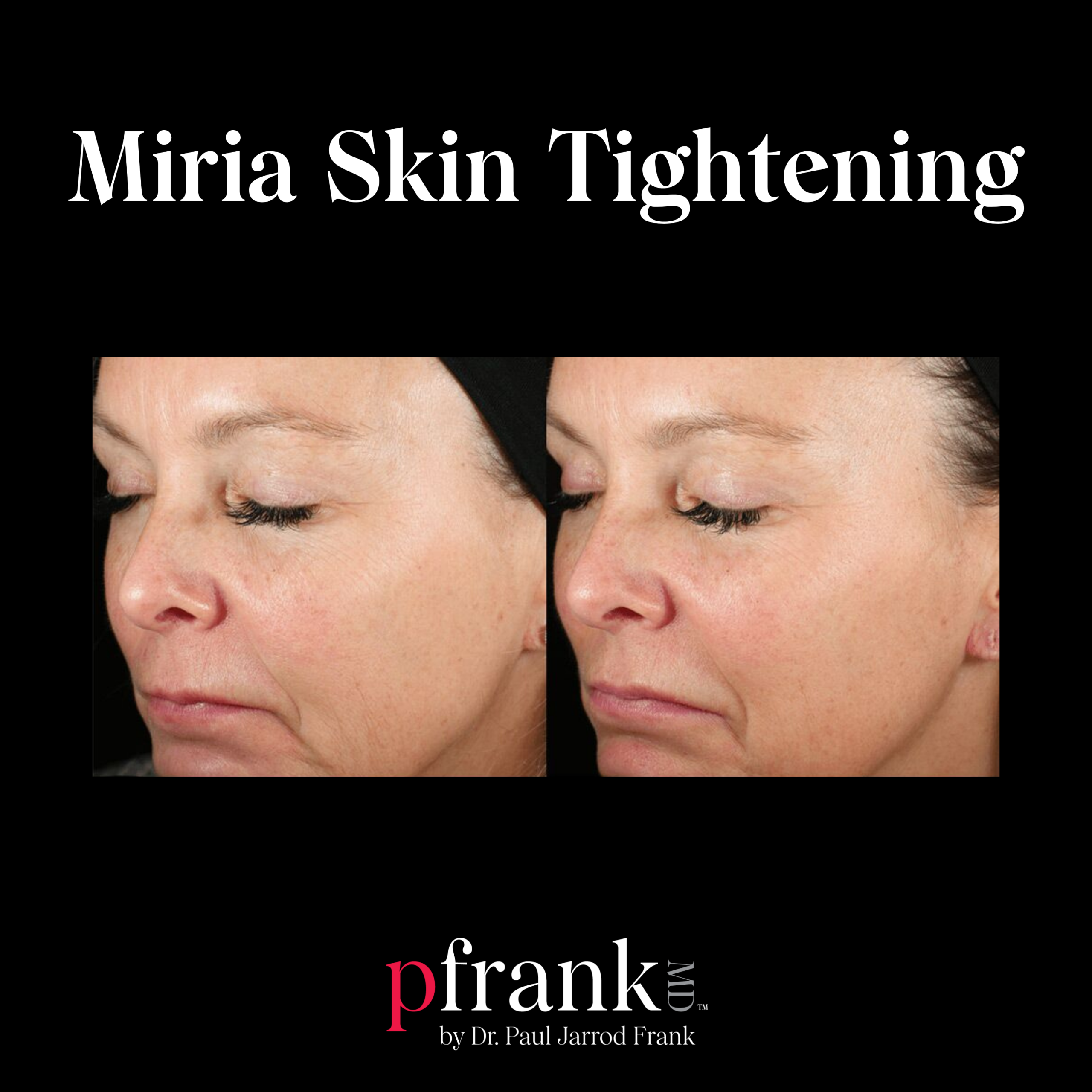 Miria for Skin Tightening