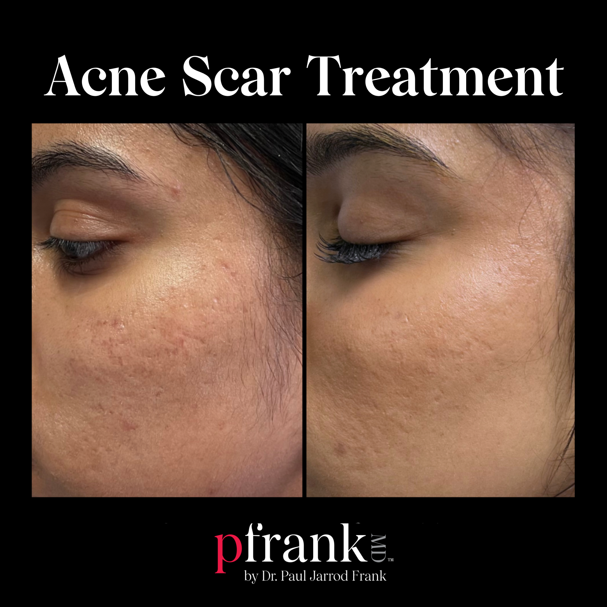 Miria for Acne