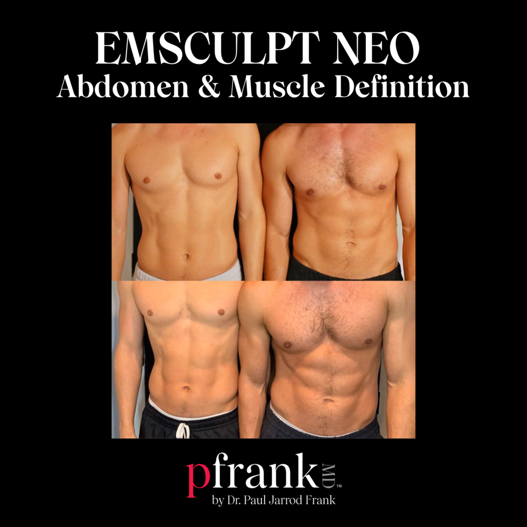 Emsculpt for Abdominal Rejuvenation