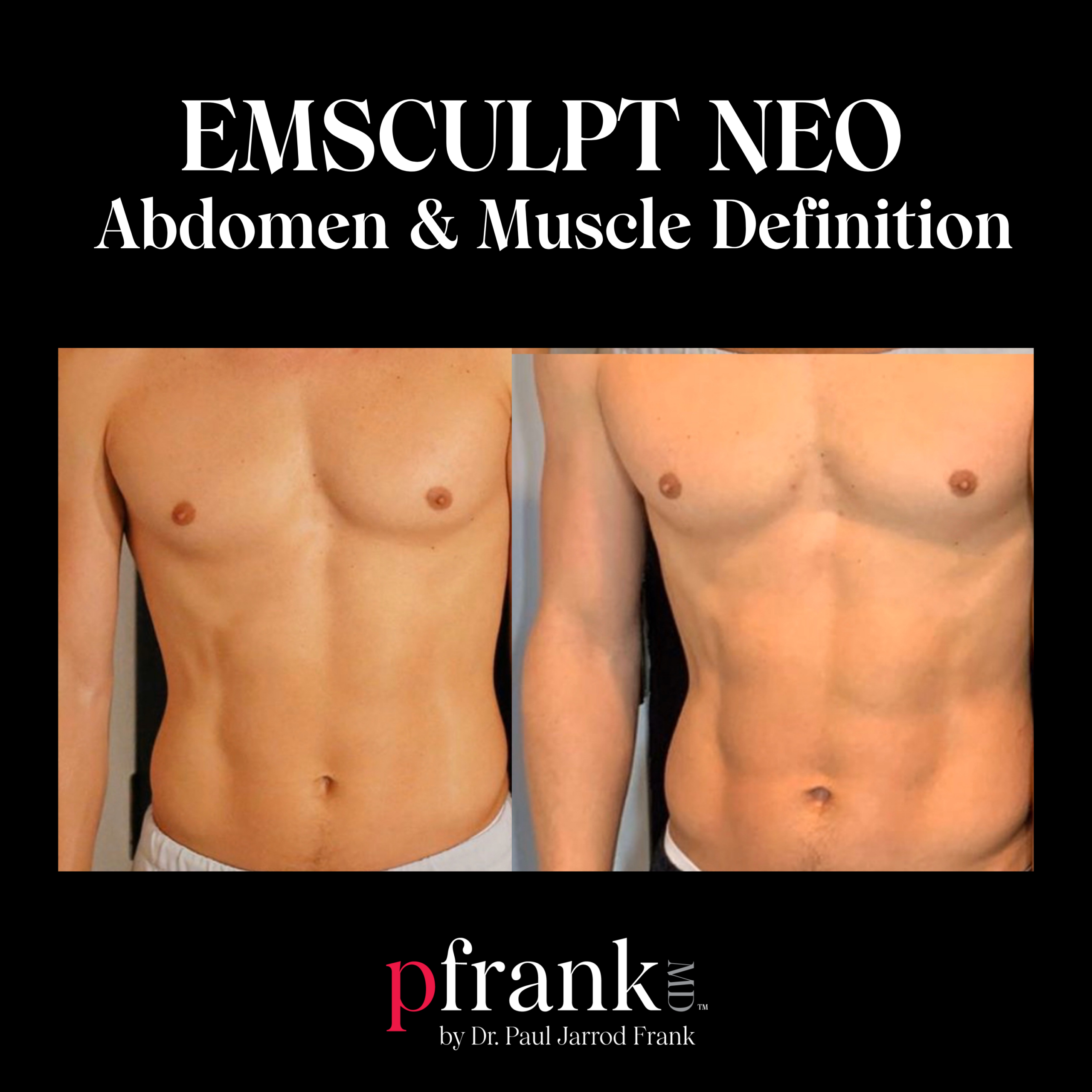 Emsculpt for Abdominal Rejuvenation