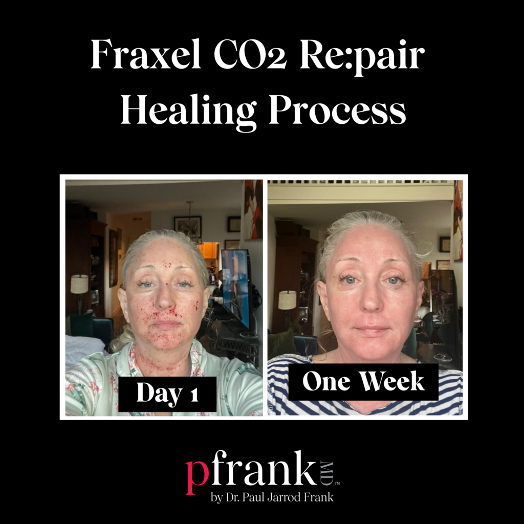 Fraxel CO2 Repair Healing Process