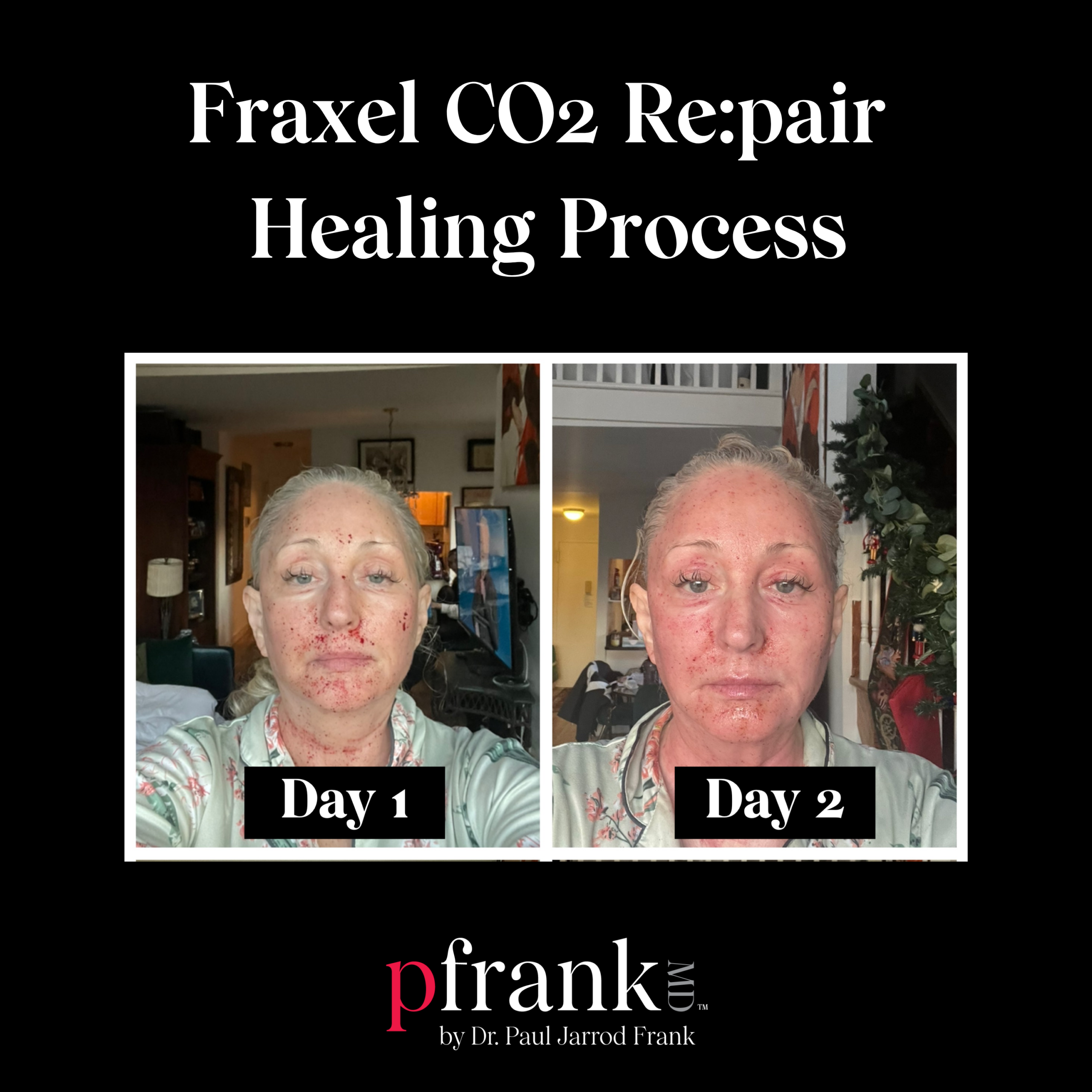 Fraxel CO2 Repair Healing Process