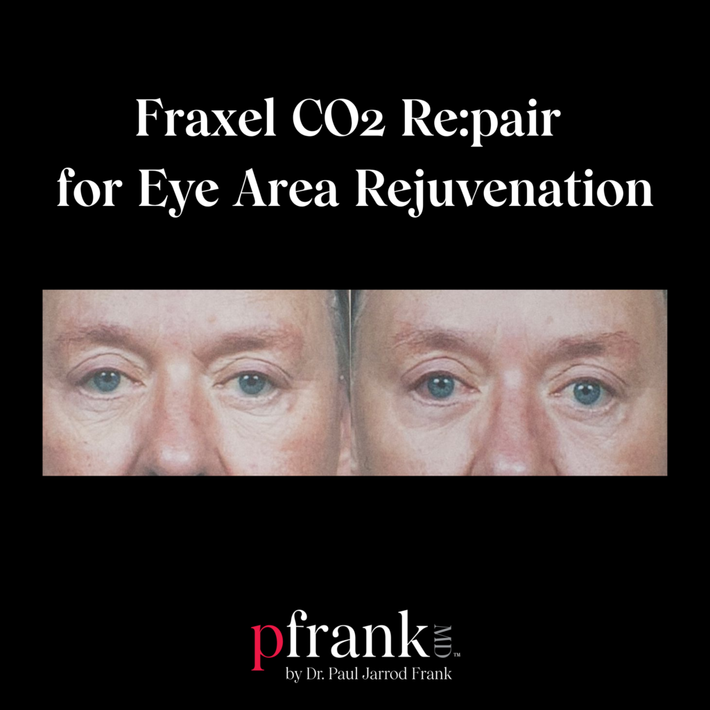 Fraxel Repair Co2 Laser for Fine Lines and Wrinkles Around the Eye
