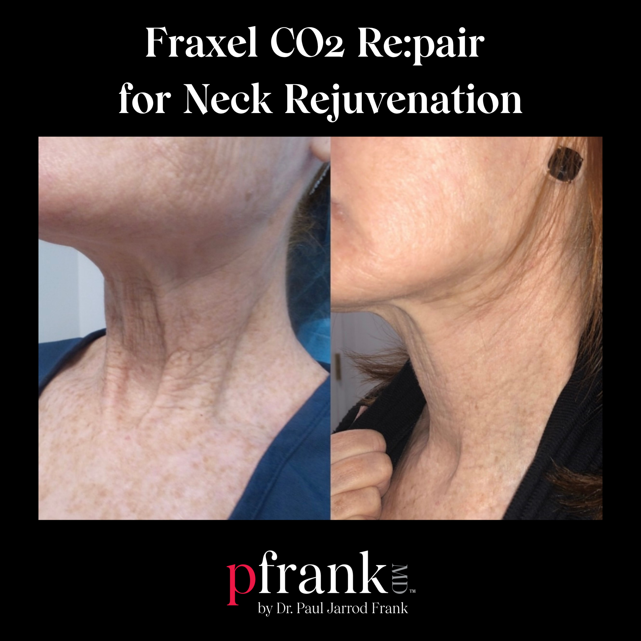 Fraxel Co2 Repair for Skin Tightening on the Neck
