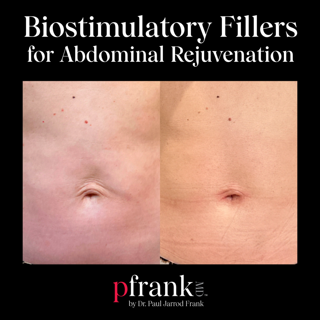 Biostimulatory Fillers for Abdominal Rejuvenation