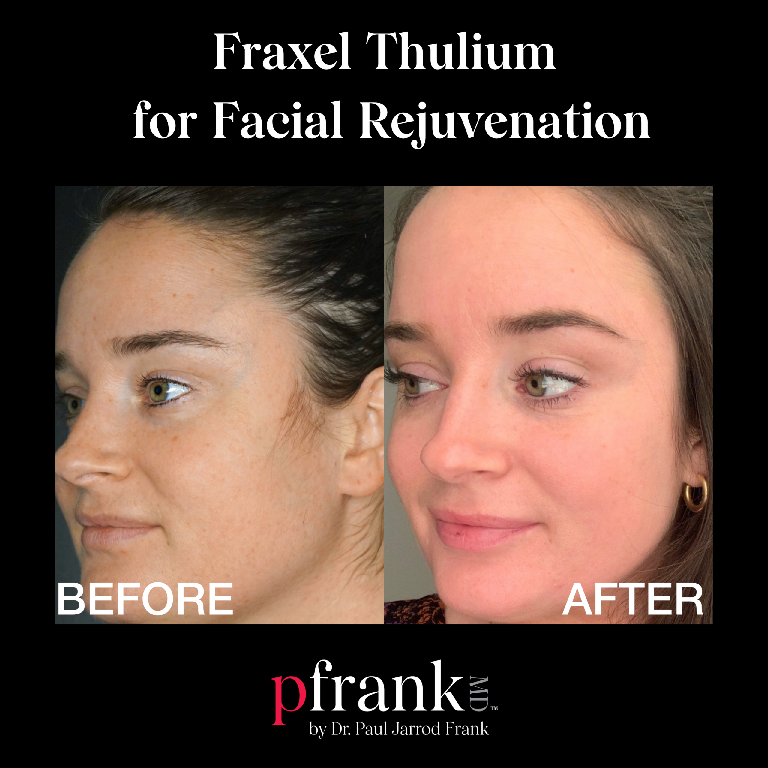 Fraxel for Skin Resurfacing and Sun Damage