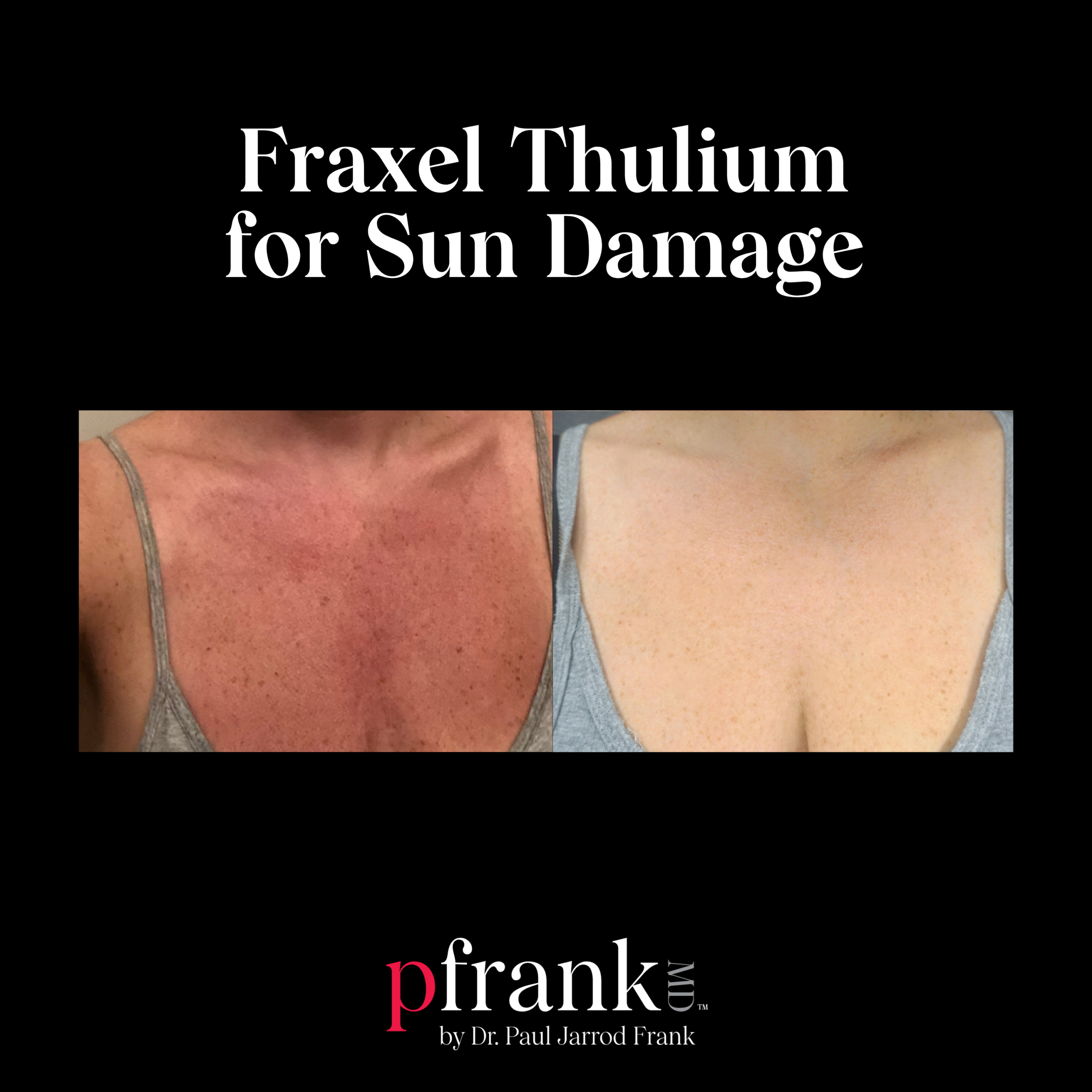 Fraxel for Sun Spots
