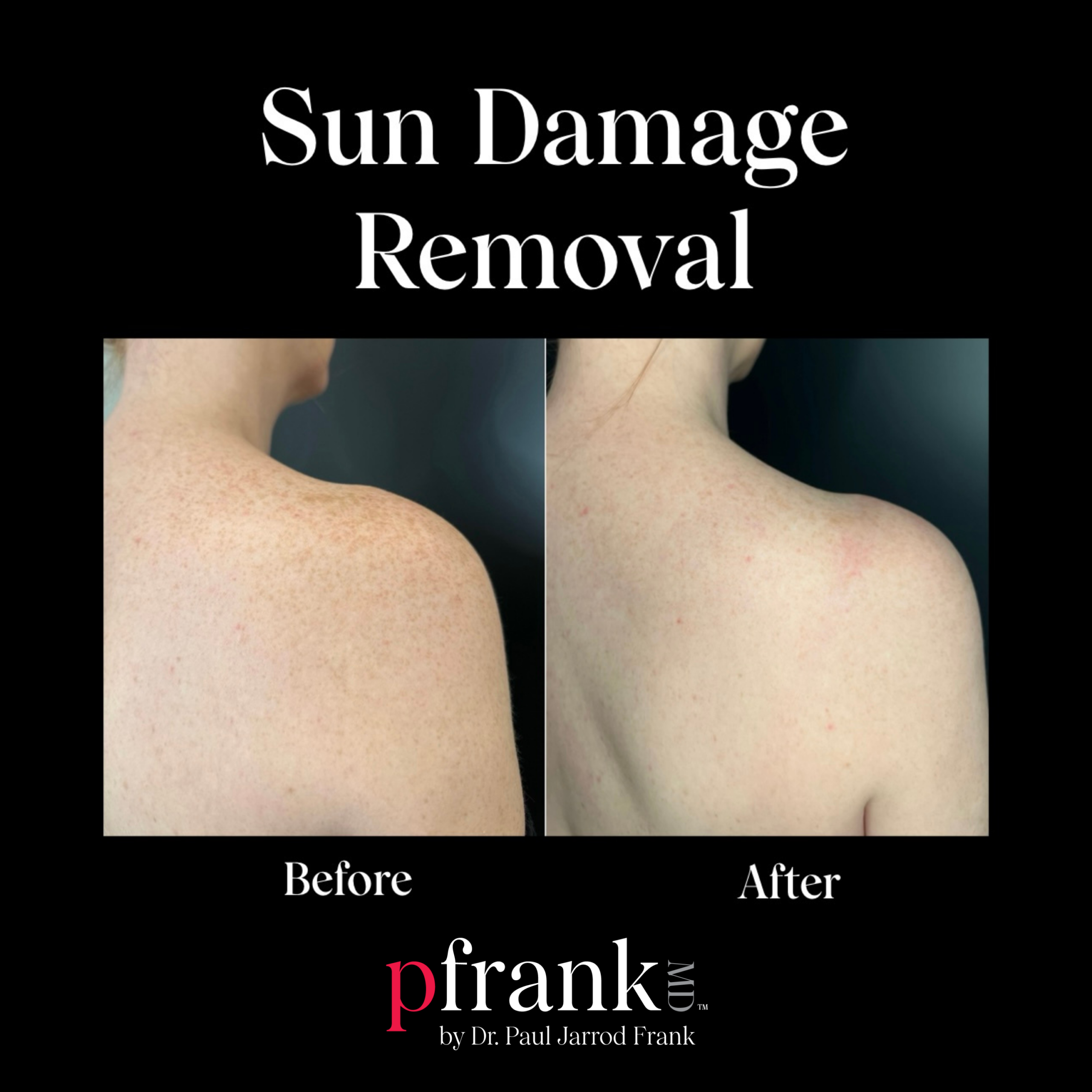Fraxel for Sun Damage