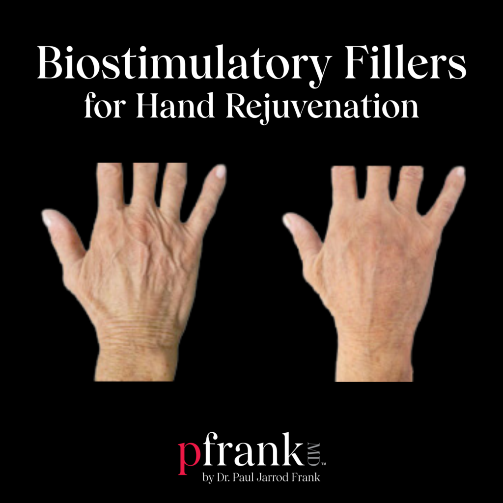 Biostimulatory Fillers for Hand Rejuvenation