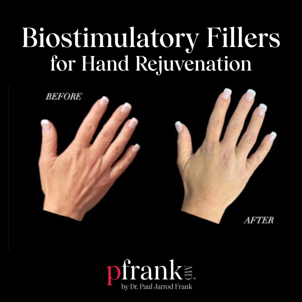 Biostimulatory Fillers for Hand Rejuvenation
