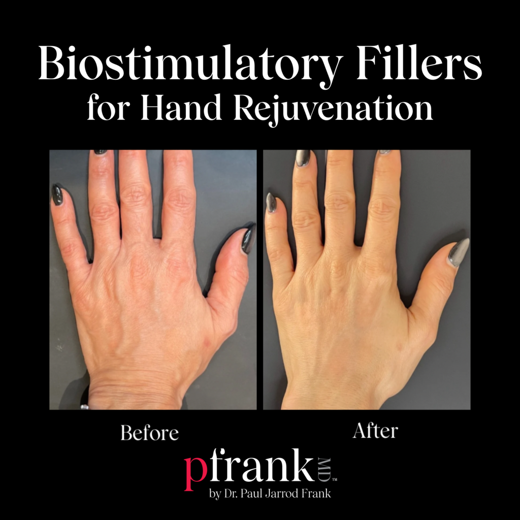 Biostimulatory Fillers for Hand Rejuvenation