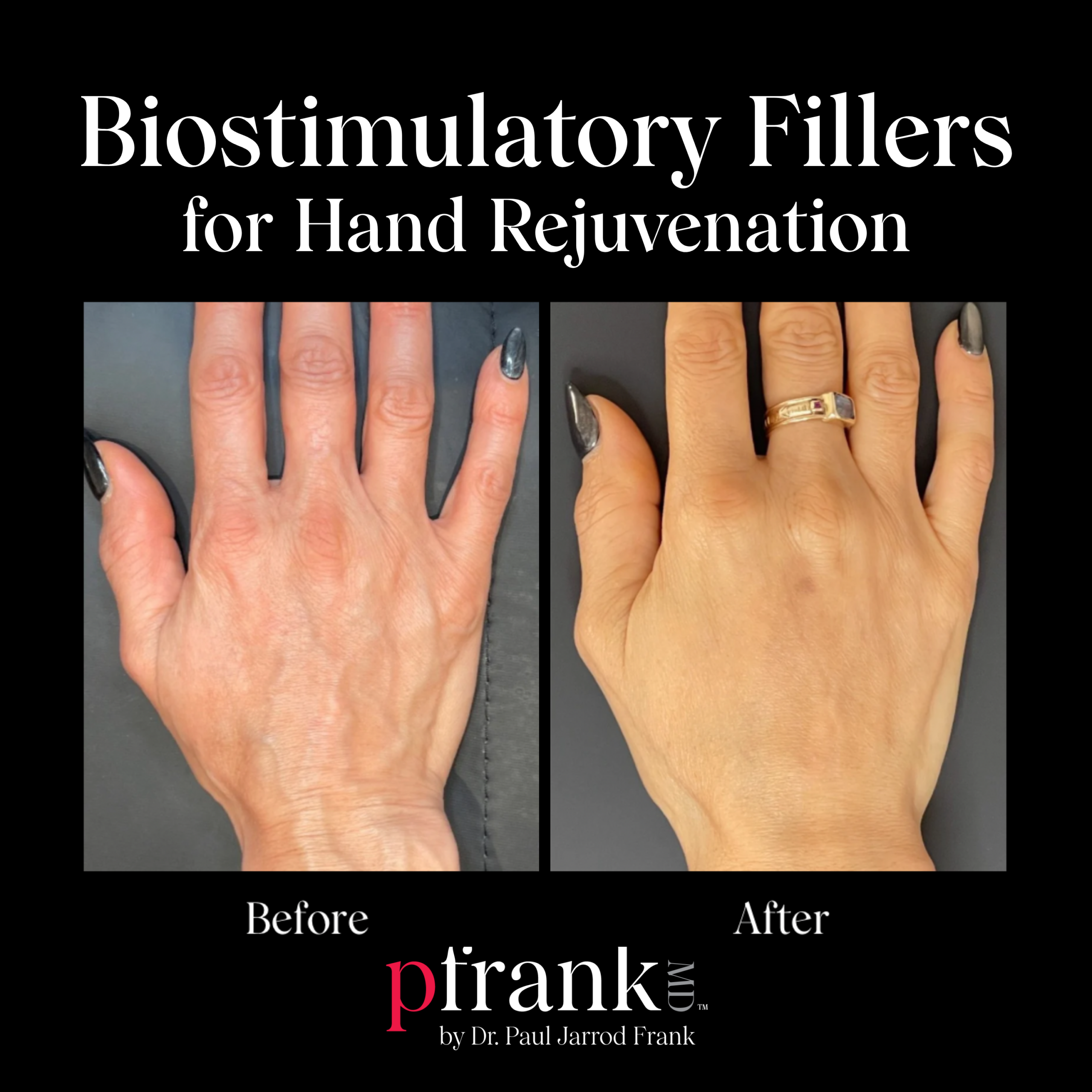 Biostimulatory Fillers for Hand Rejuvenation