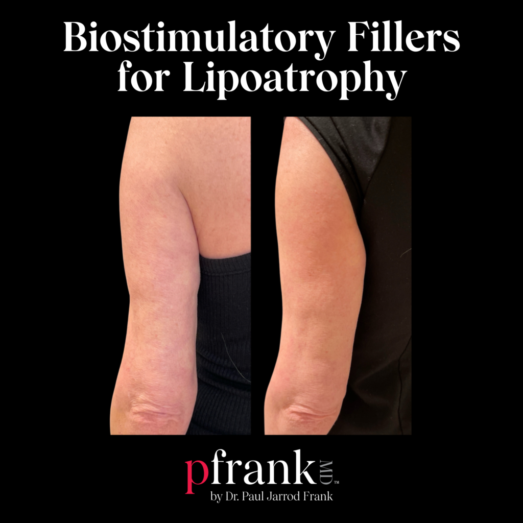 Biostimulatory Fillers for Lipoatrophy