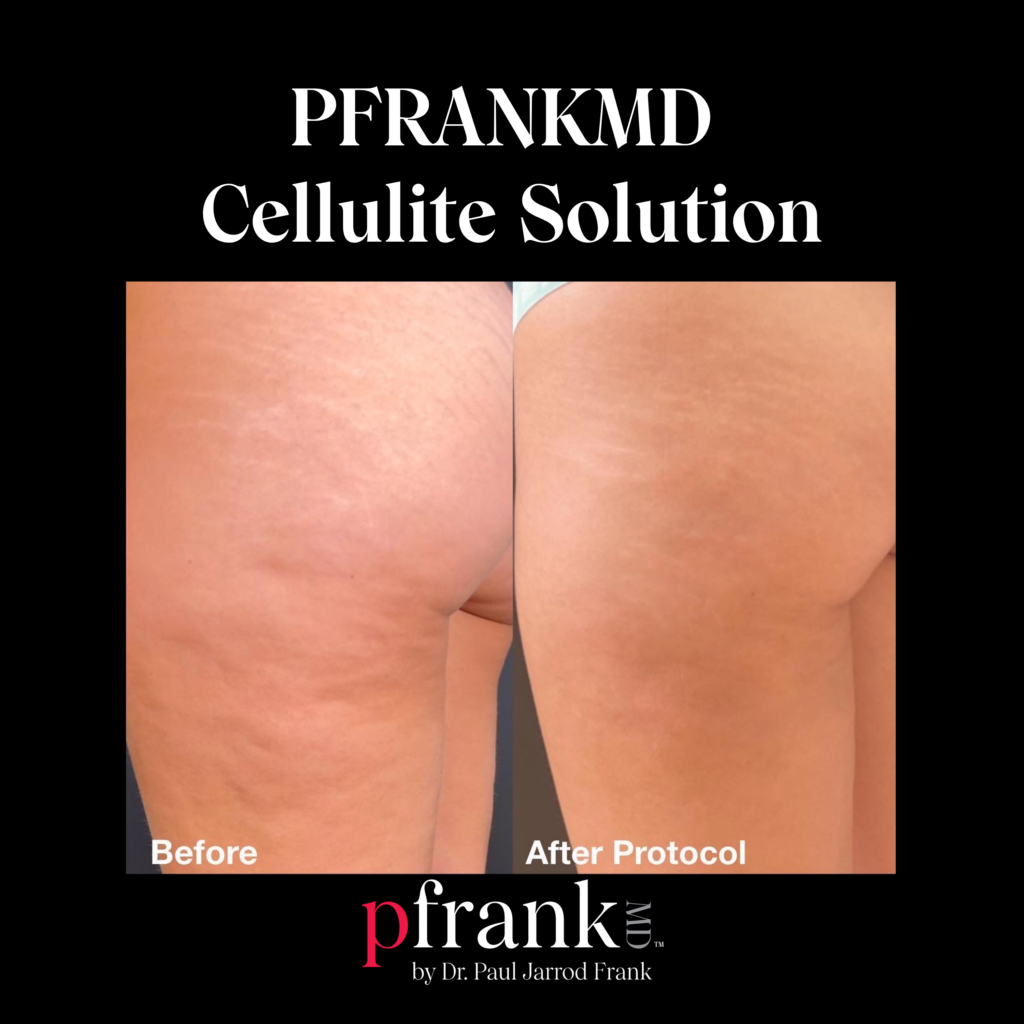 Biostimulatory Fillers for Cellulite