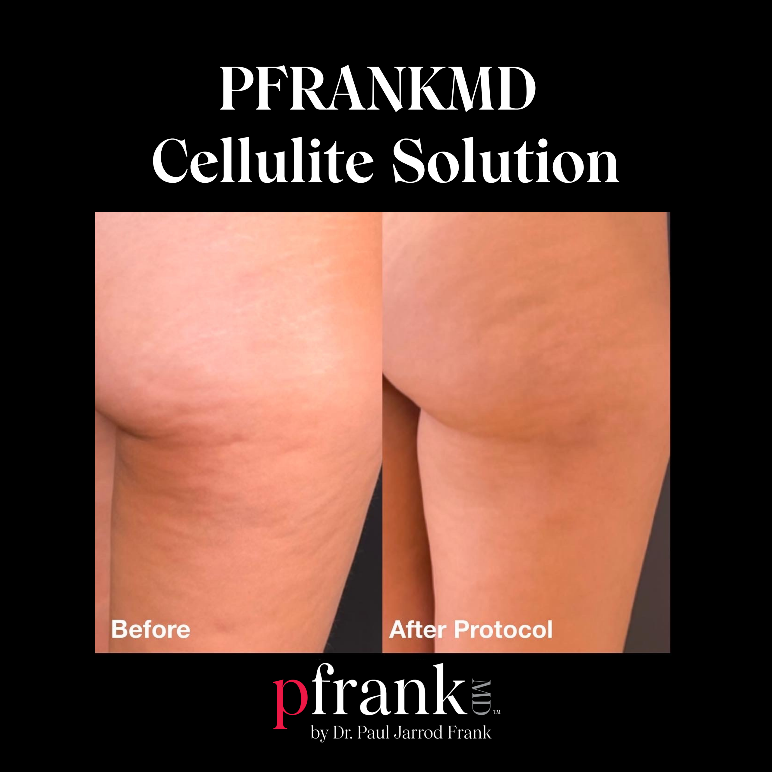 Biostimulatory Fillers for Cellulite