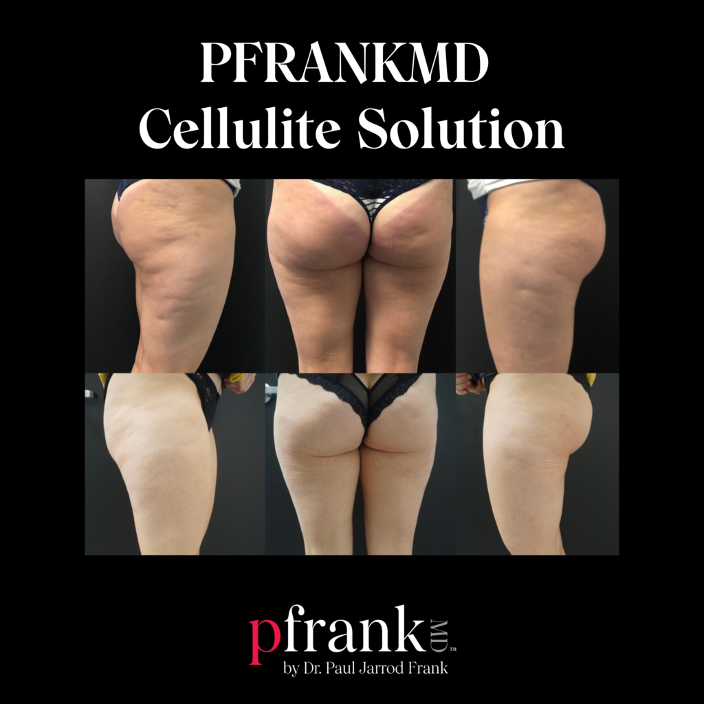 Biostimulatory Fillers for Cellulite