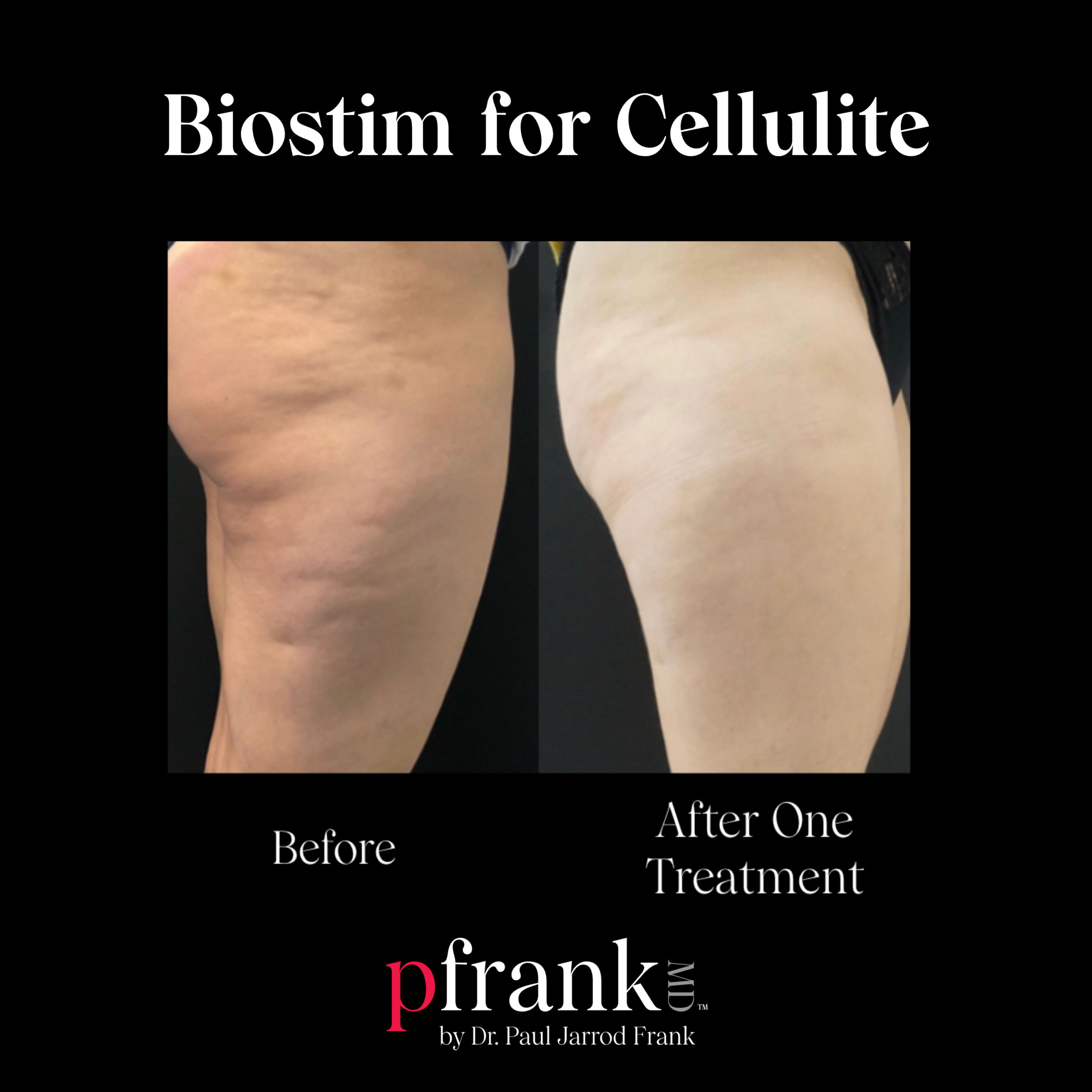 Biostimulatory Fillers for Cellulite