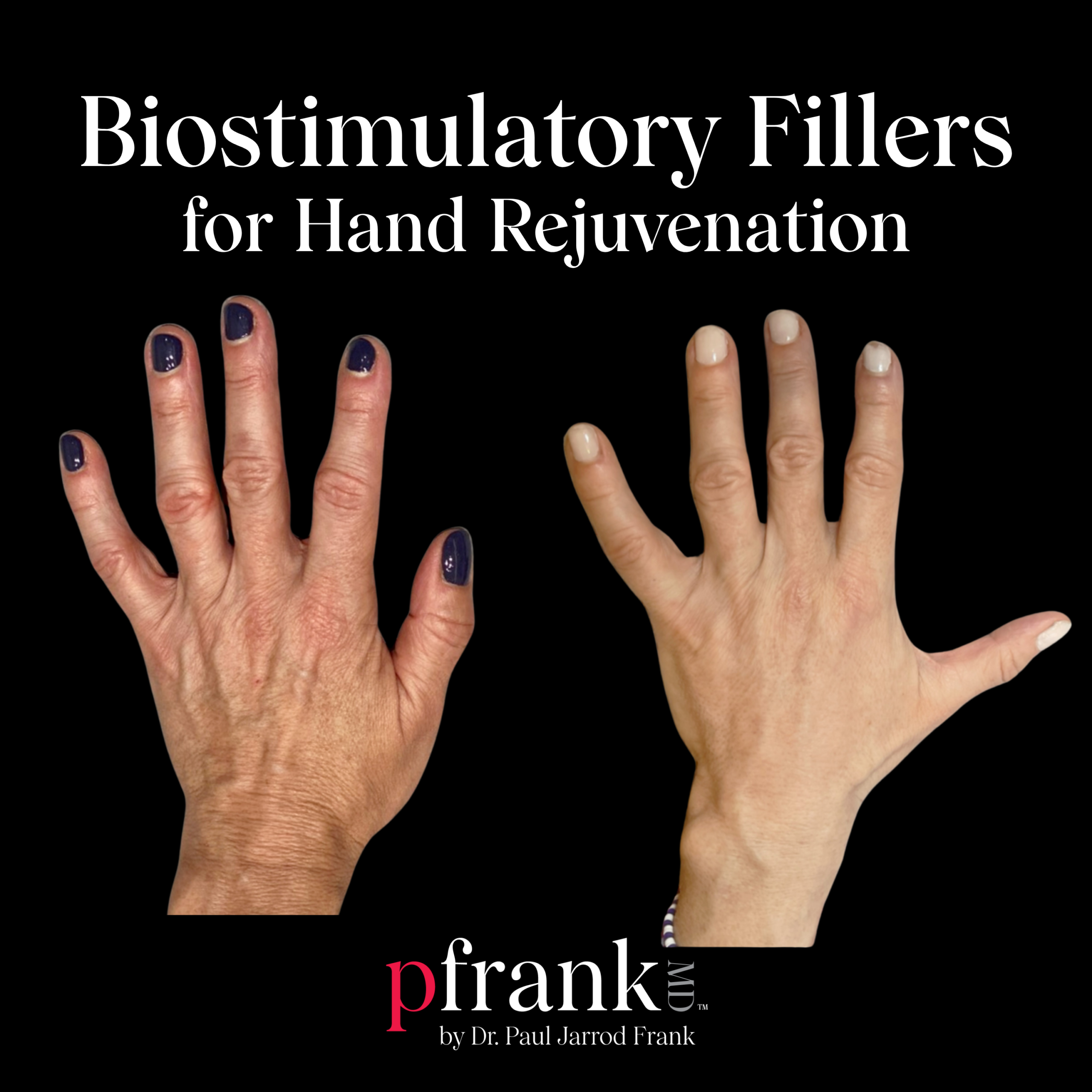Biostimulatory Fillers for Hand Rejuvenation