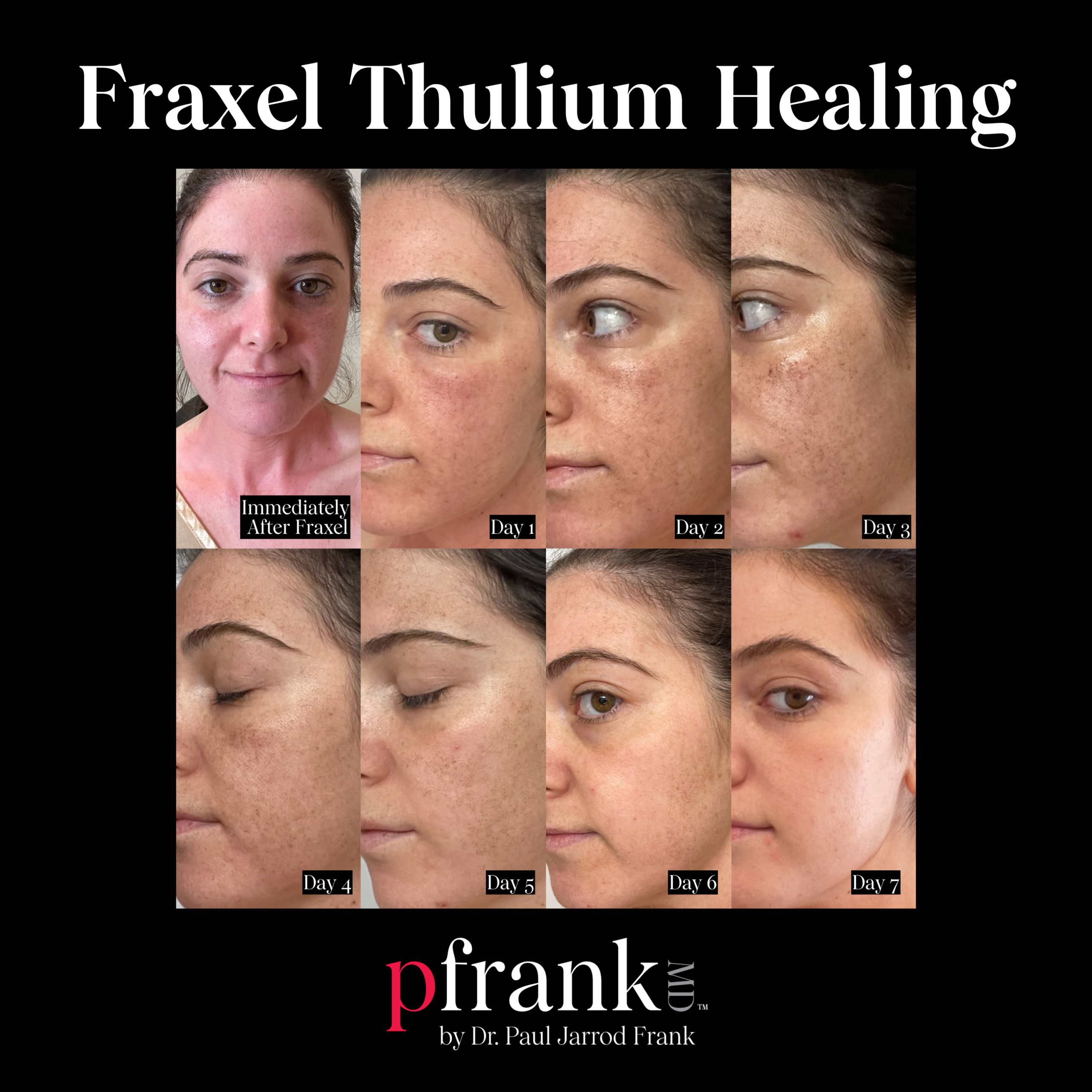 Fraxel for Sun Damage