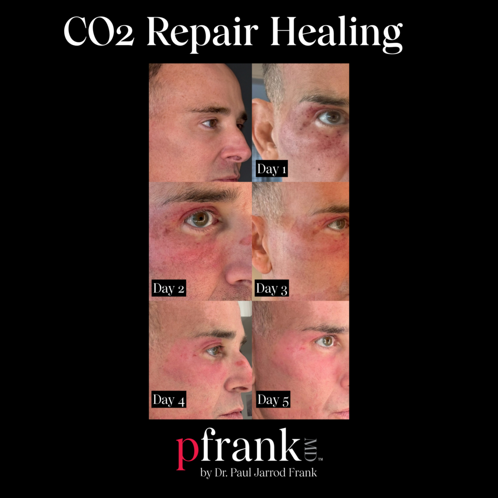 Fraxel Repair CO2 Healing