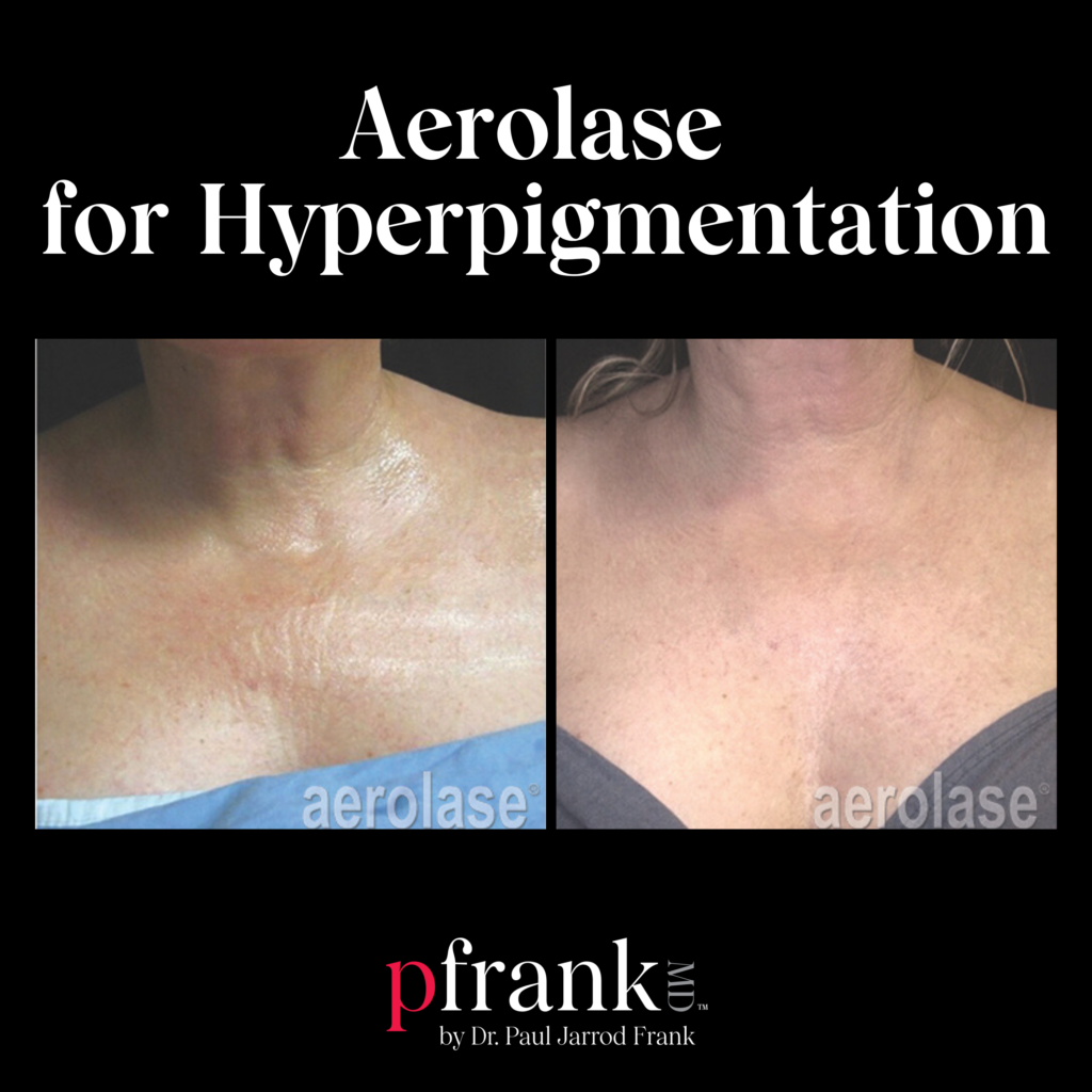 Aerolase for Neck and Chest Rejuvenation