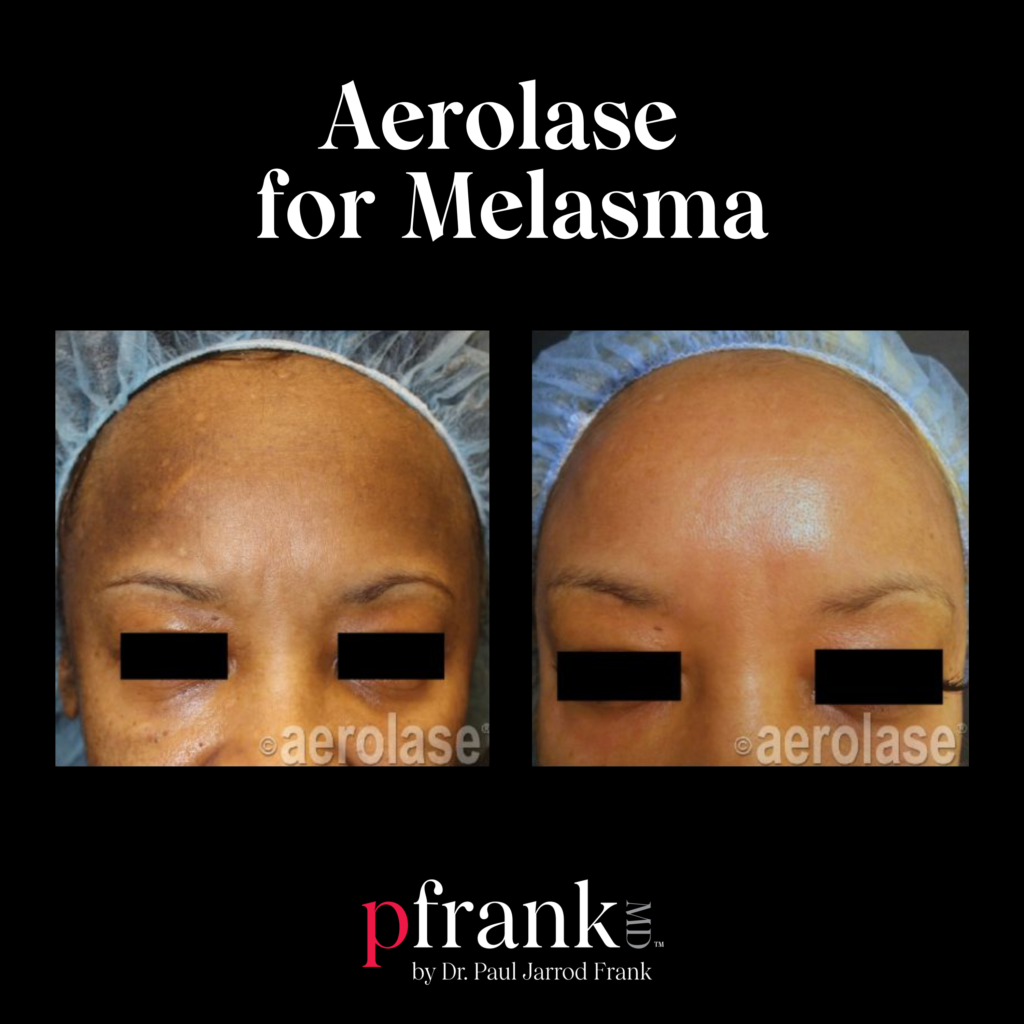 Aerolase for Melasma on Forehead